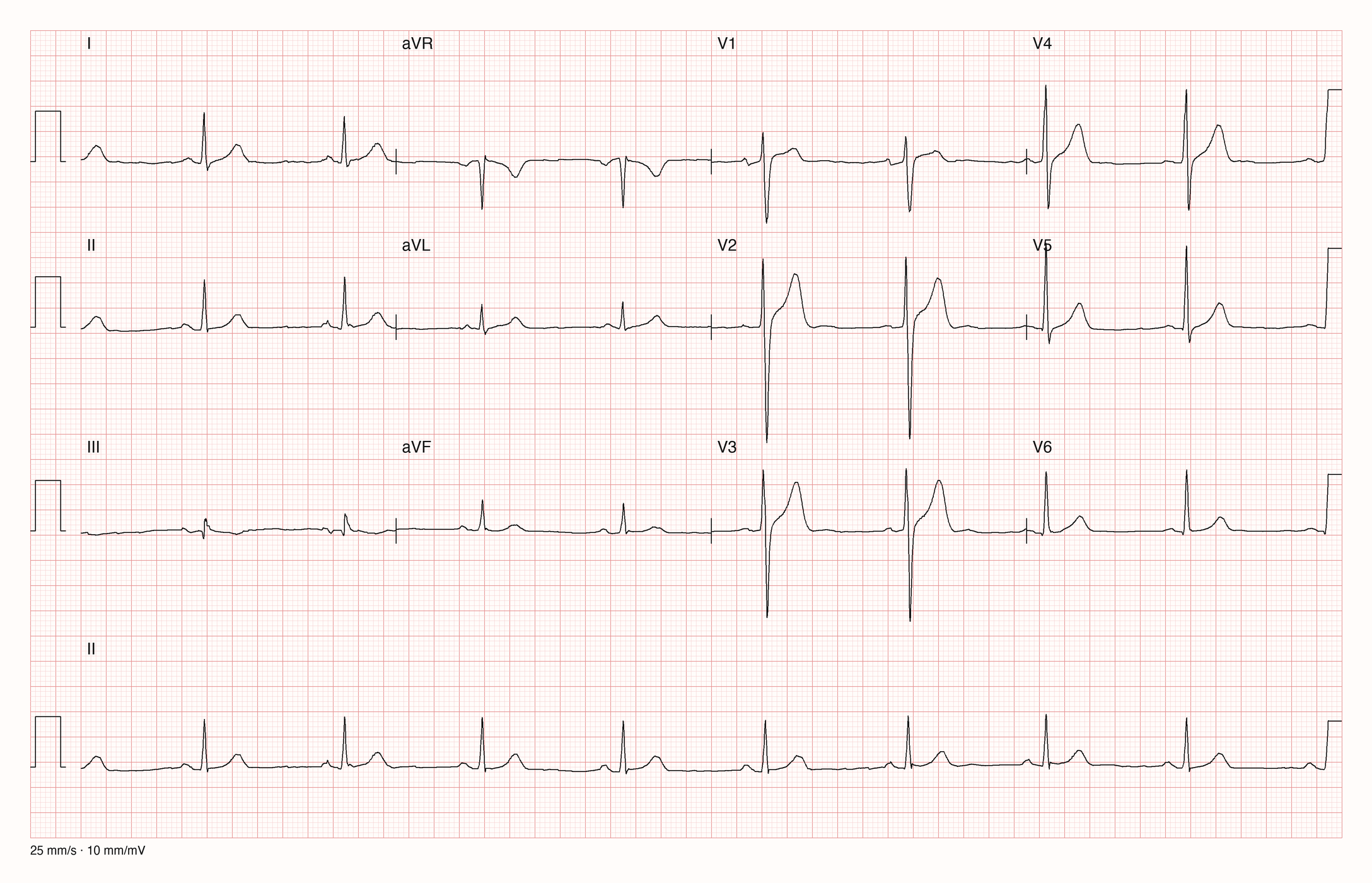 12-Kanal-EKG mit Rhythmusstreifen II, Datensatzkennung 5915