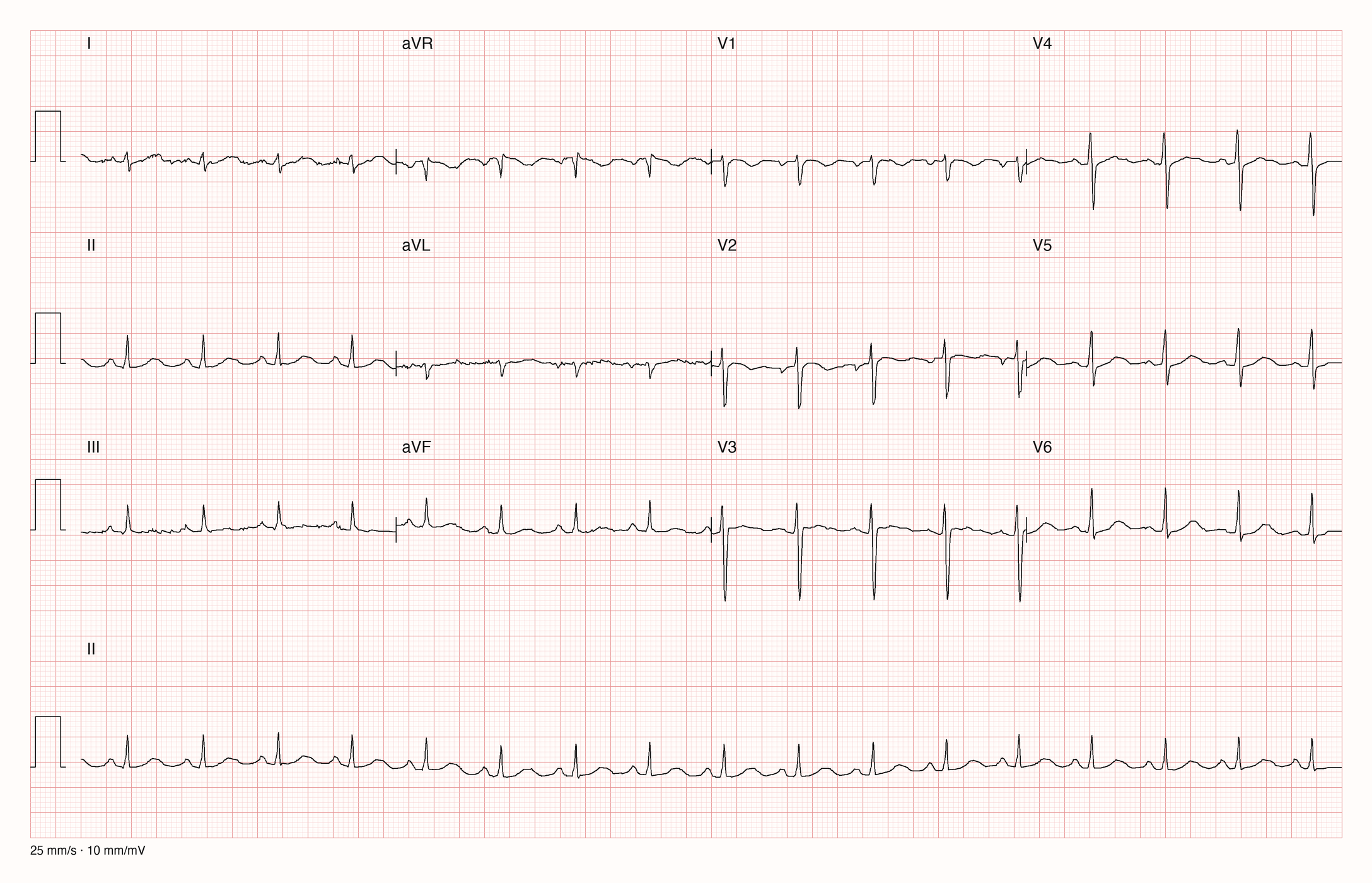 12-Kanal-EKG mit Rhythmusstreifen II, Datensatzkennung 6031