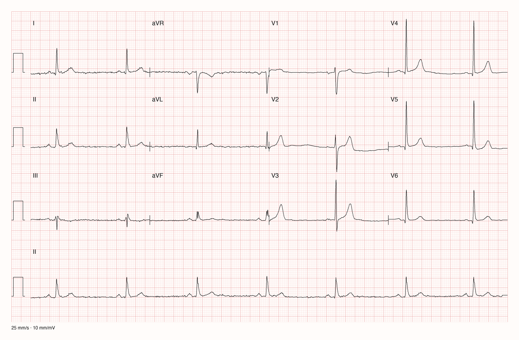 12-Kanal-EKG mit Rhythmusstreifen II, Datensatzkennung 611
