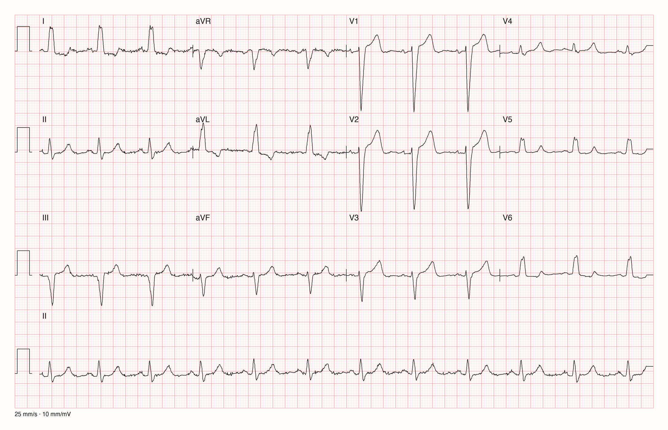 EKG-Aufnahme PTBXL-618; beurteile zunächst selbst die sichtbare Kurve
