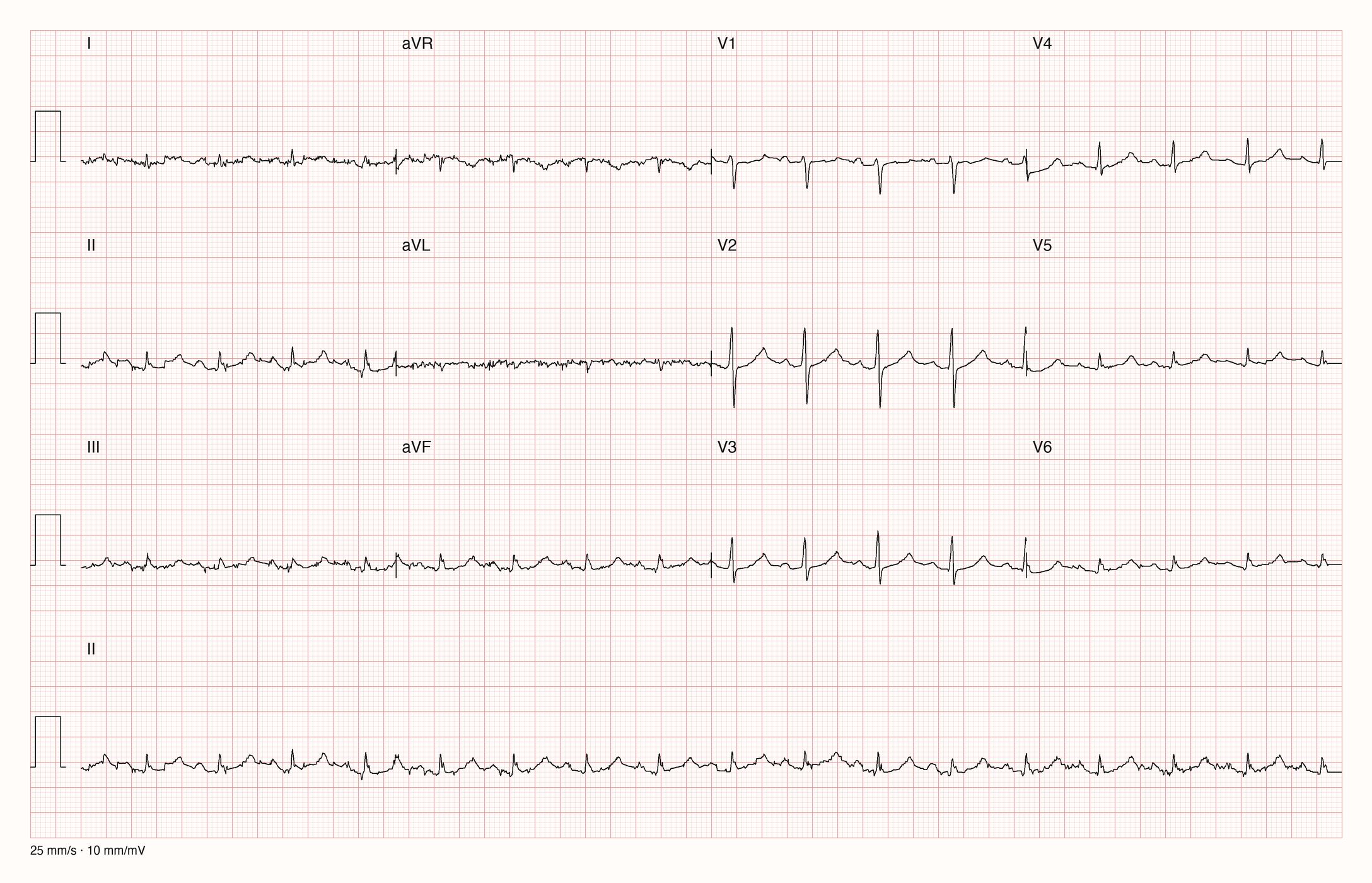 12-Kanal-EKG mit Rhythmusstreifen II, Datensatzkennung 6515
