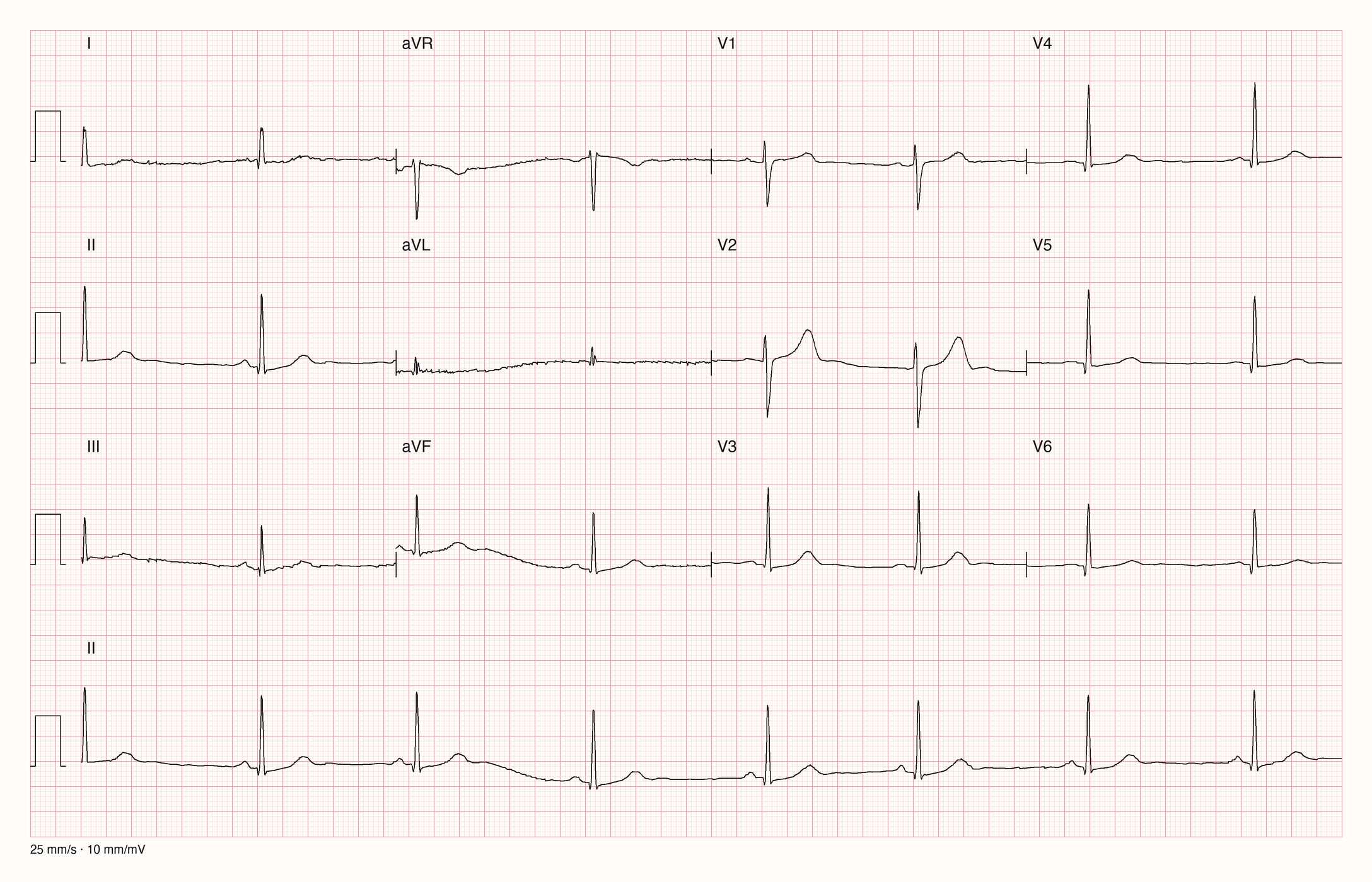 12-Kanal-EKG mit Rhythmusstreifen II, Datensatzkennung 69
