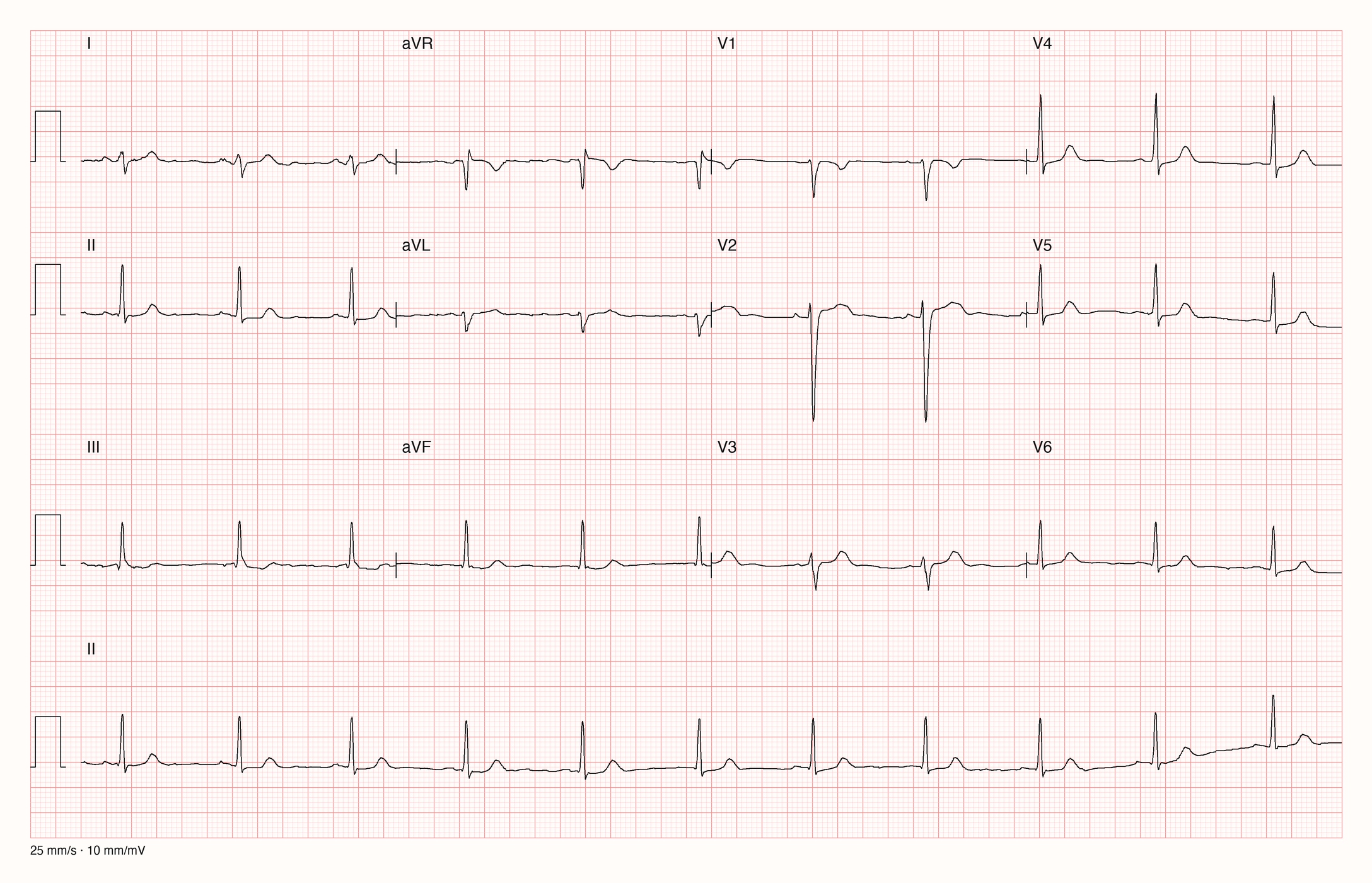 12-Kanal-EKG mit Rhythmusstreifen II, Datensatzkennung 7031