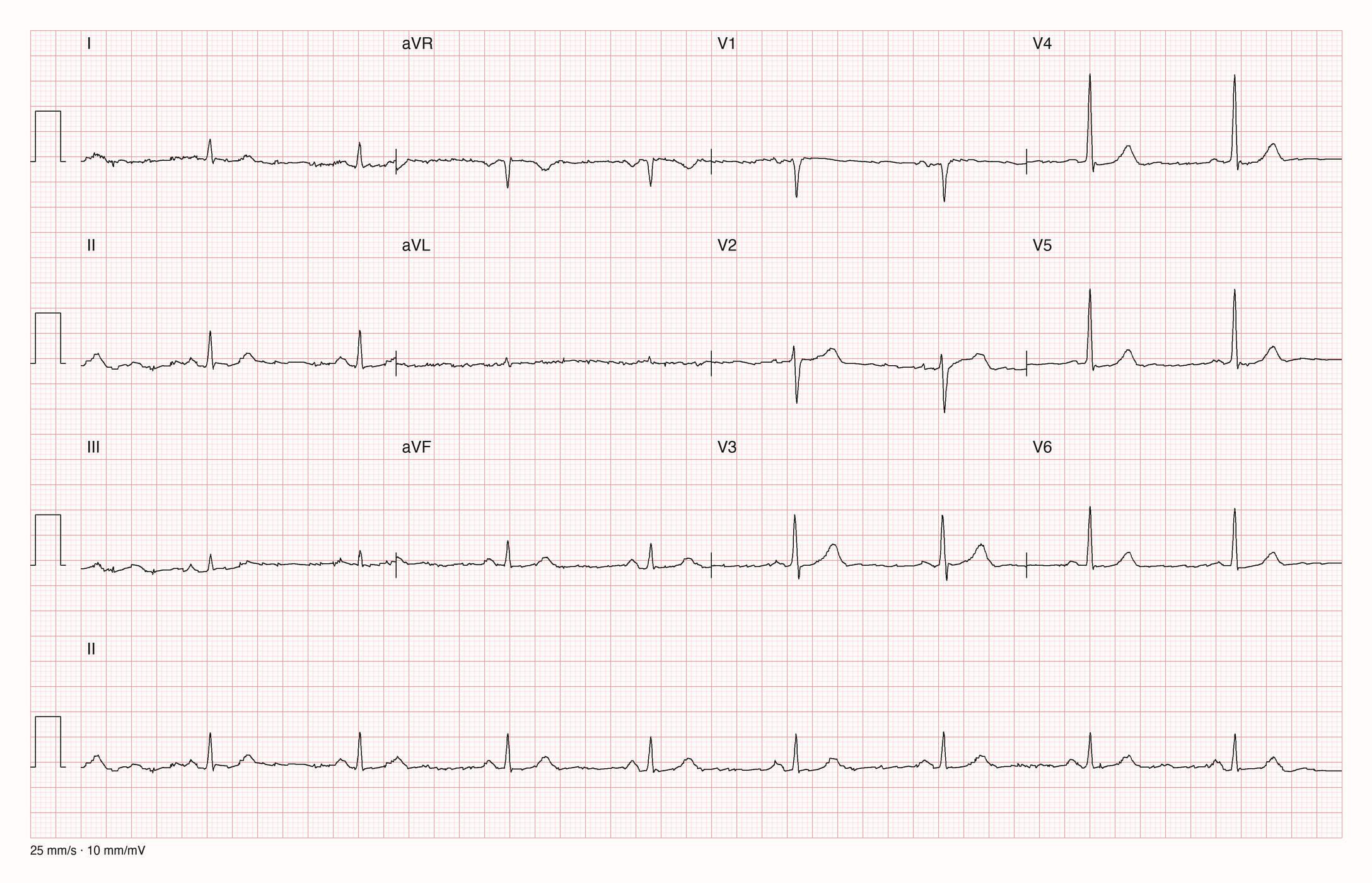 12-Kanal-EKG mit Rhythmusstreifen II, Datensatzkennung 7161