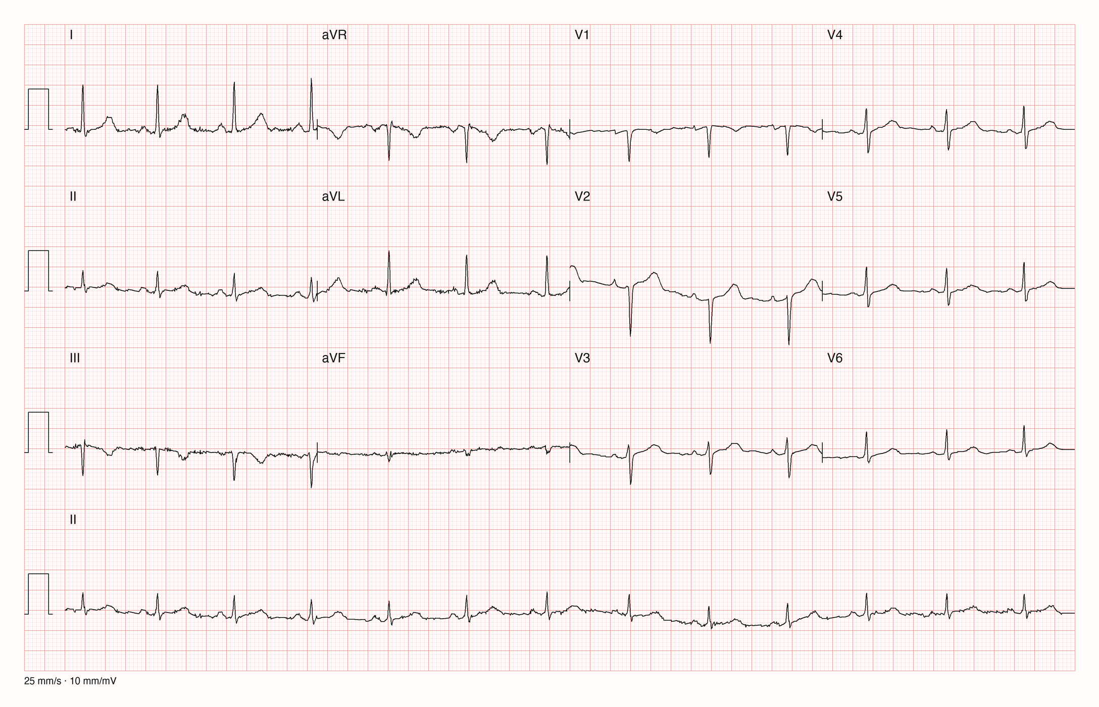 12-Kanal-EKG mit Rhythmusstreifen II, Datensatzkennung 772