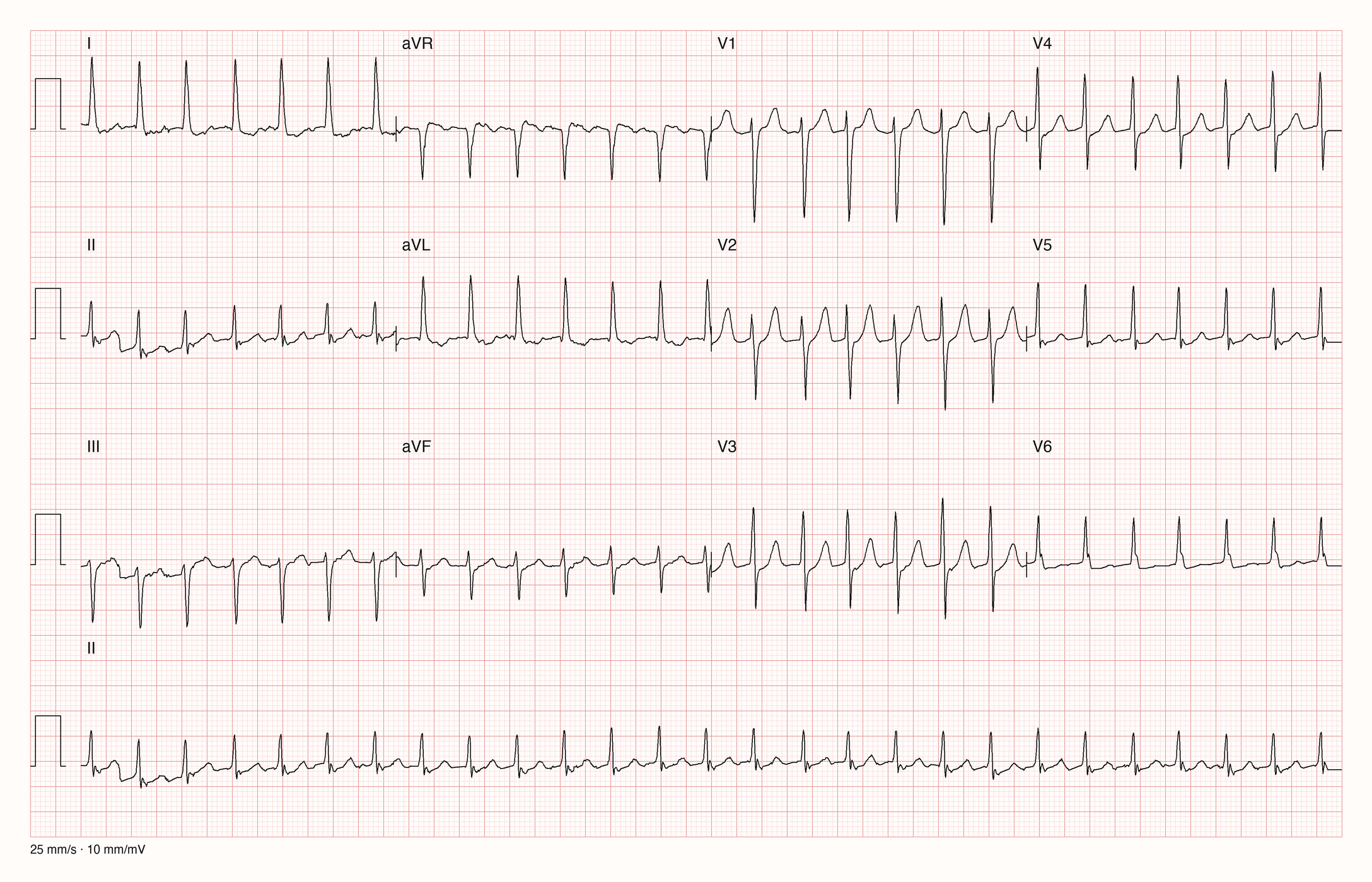 12-Kanal-EKG mit Rhythmusstreifen II, Datensatzkennung 7889