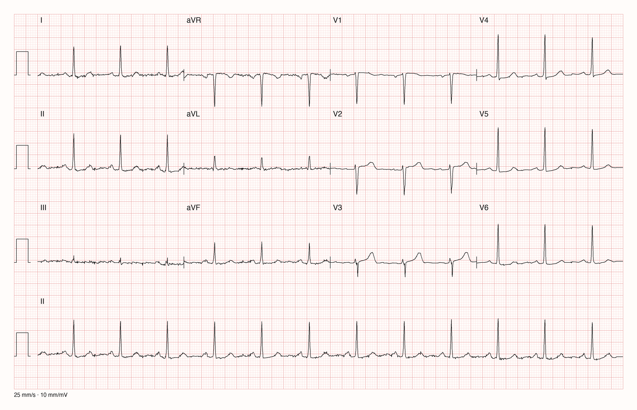 12-Kanal-EKG mit Rhythmusstreifen II, Datensatzkennung 795