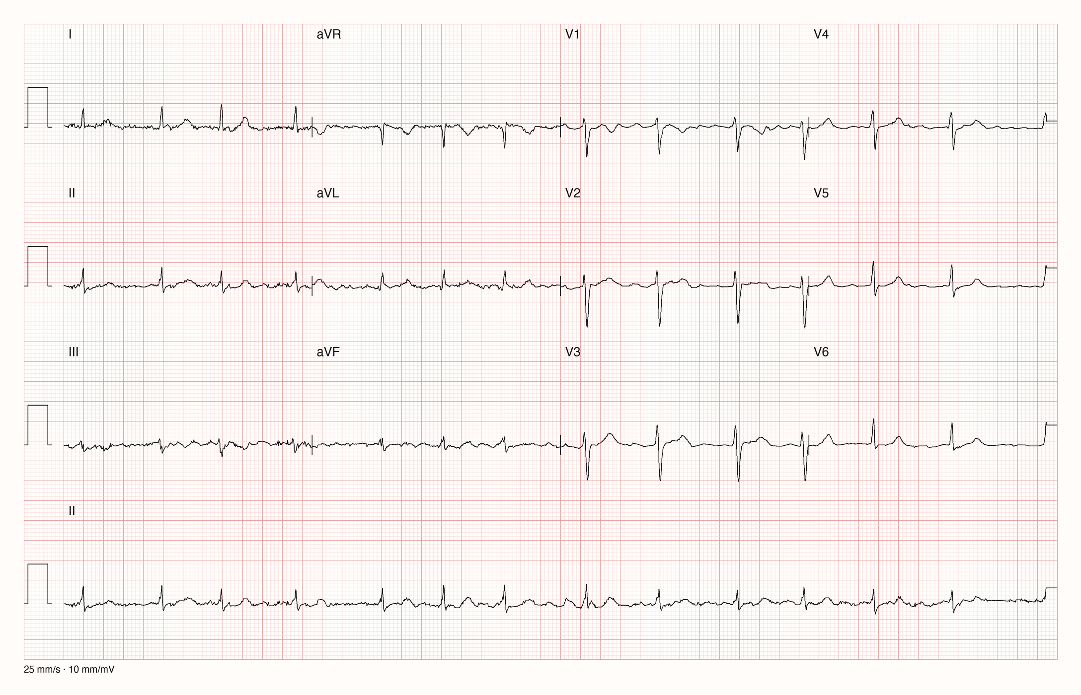 12-Kanal-EKG mit Rhythmusstreifen II, Datensatzkennung 8215