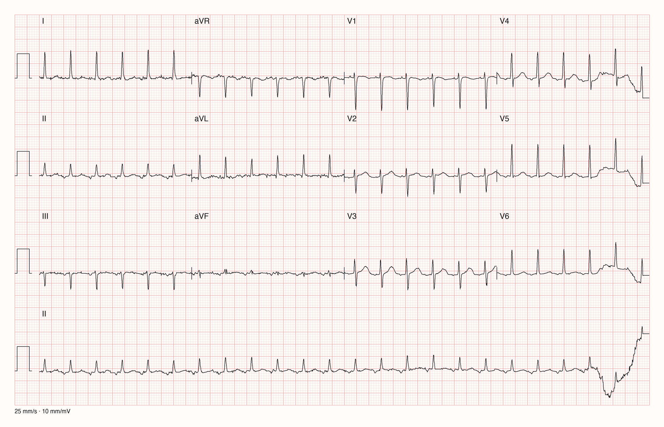 12-Kanal-EKG mit Rhythmusstreifen II, Datensatzkennung 8461