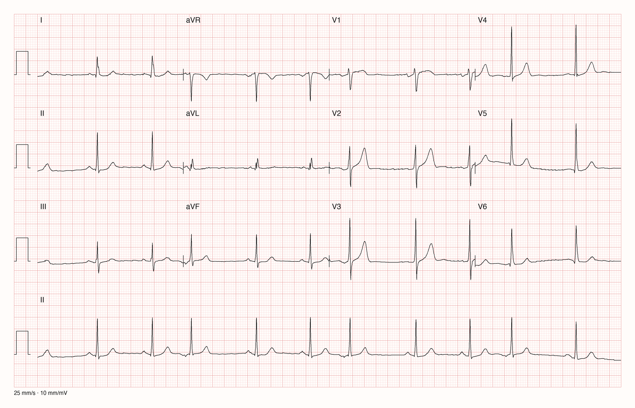 12-Kanal-EKG mit Rhythmusstreifen II, Datensatzkennung 861