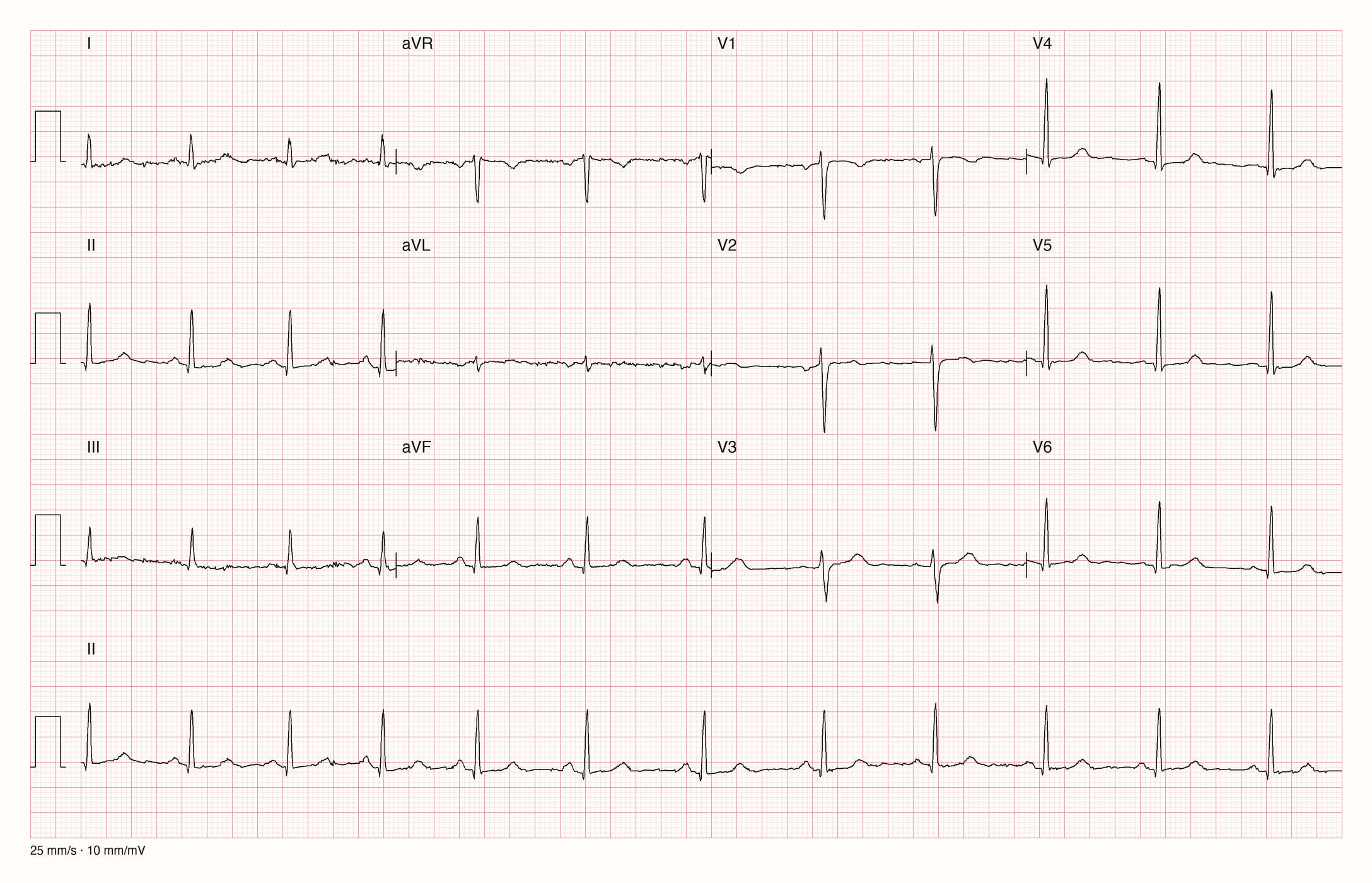 12-Kanal-EKG mit Rhythmusstreifen II, Datensatzkennung 881