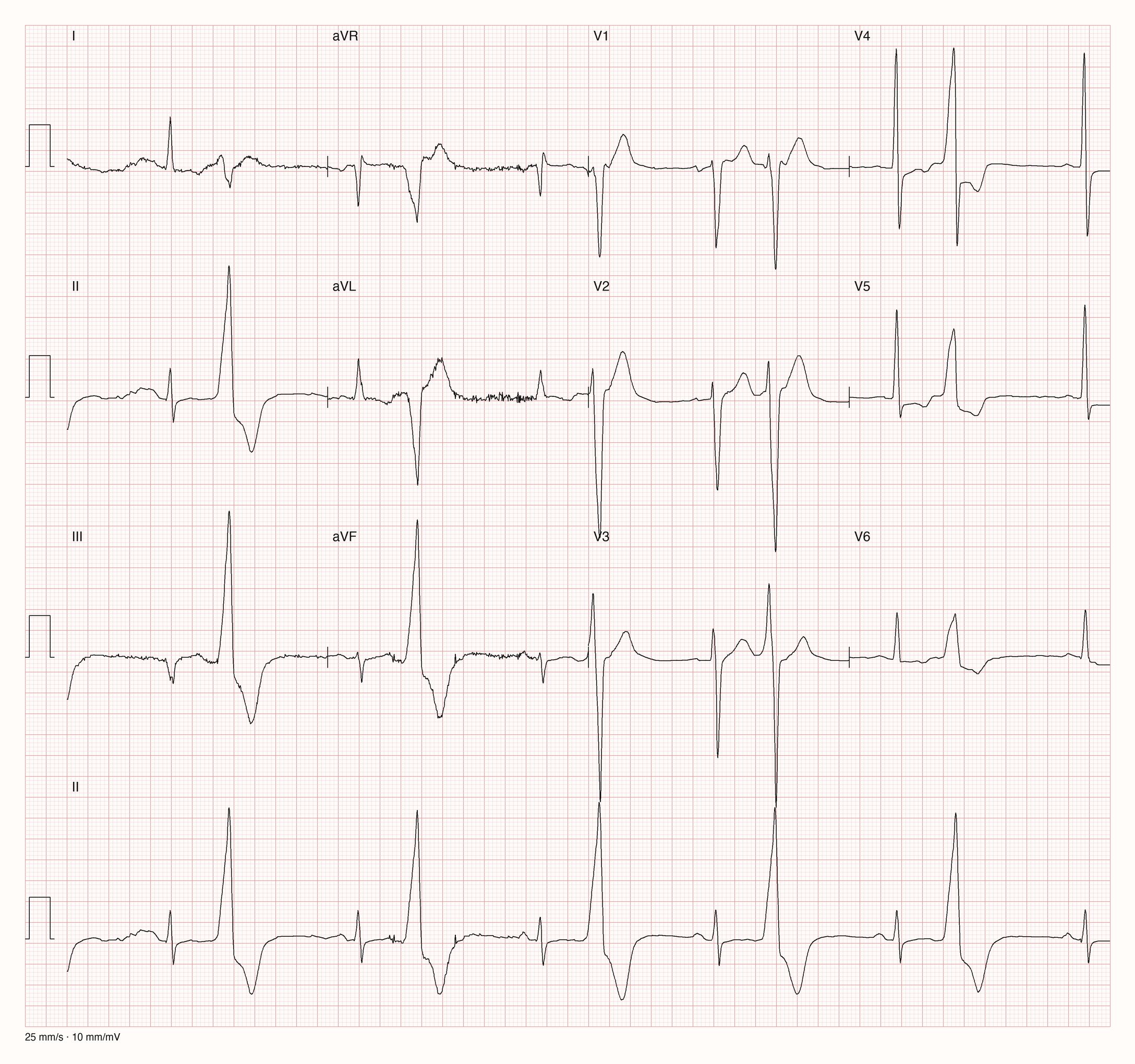 12-Kanal-EKG mit Rhythmusstreifen II, Datensatzkennung 8872