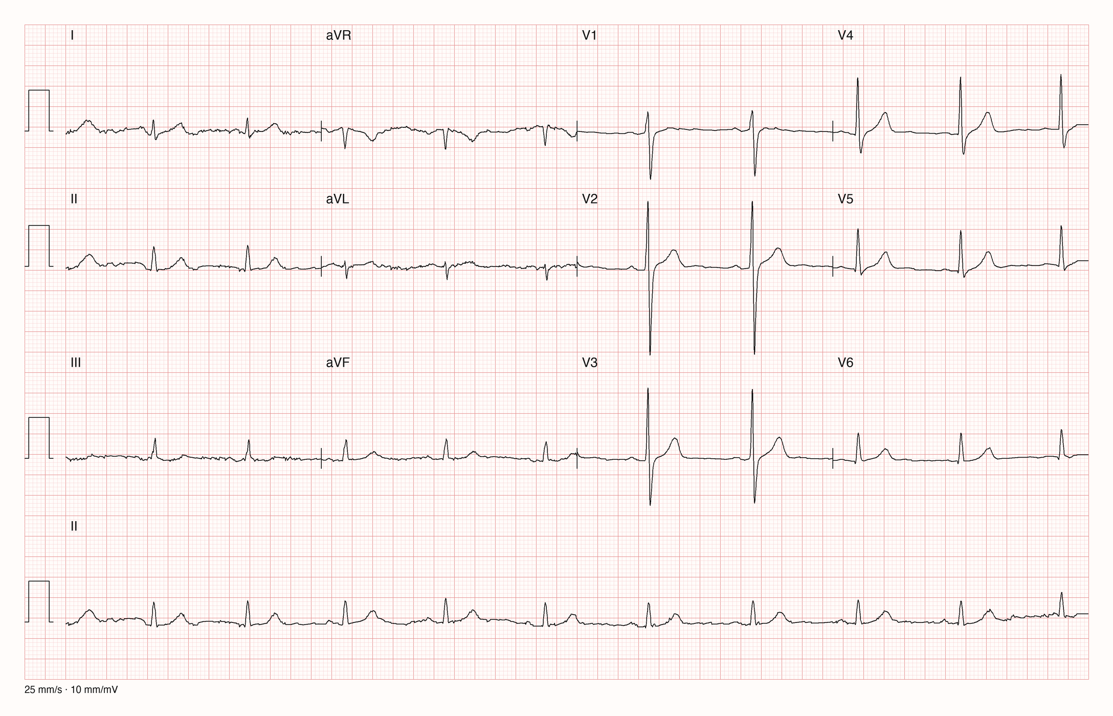 12-Kanal-EKG mit Rhythmusstreifen II, Datensatzkennung 9