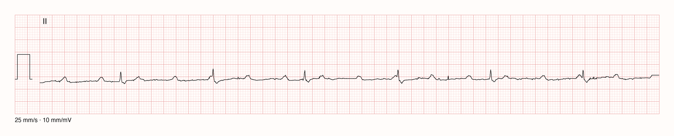 EKG-Aufnahme PTBXL-959; beurteile zunächst selbst die sichtbare Kurve