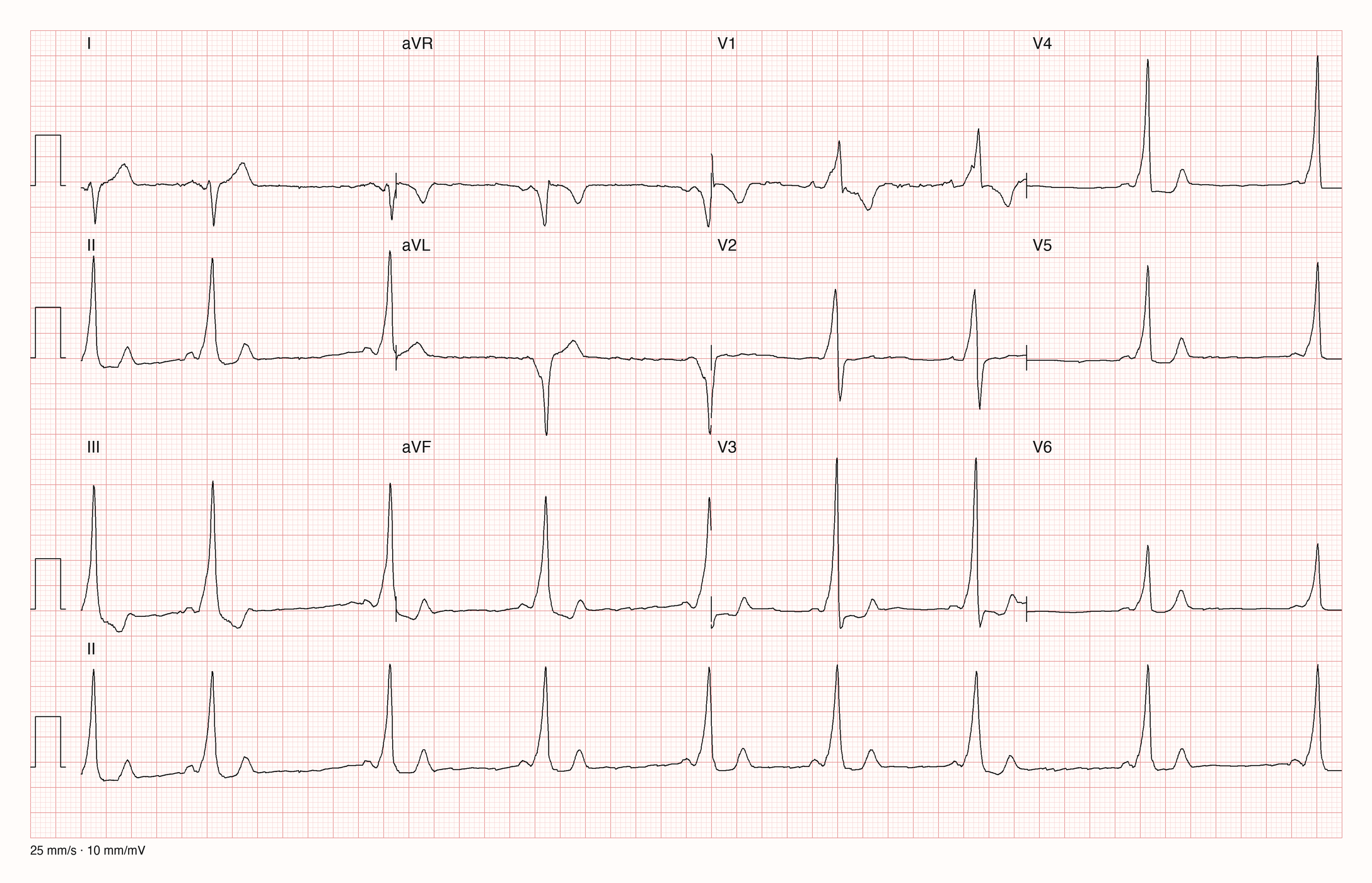 EKG-Aufnahme PTBXL-9699; beurteile zunächst selbst die sichtbare Kurve