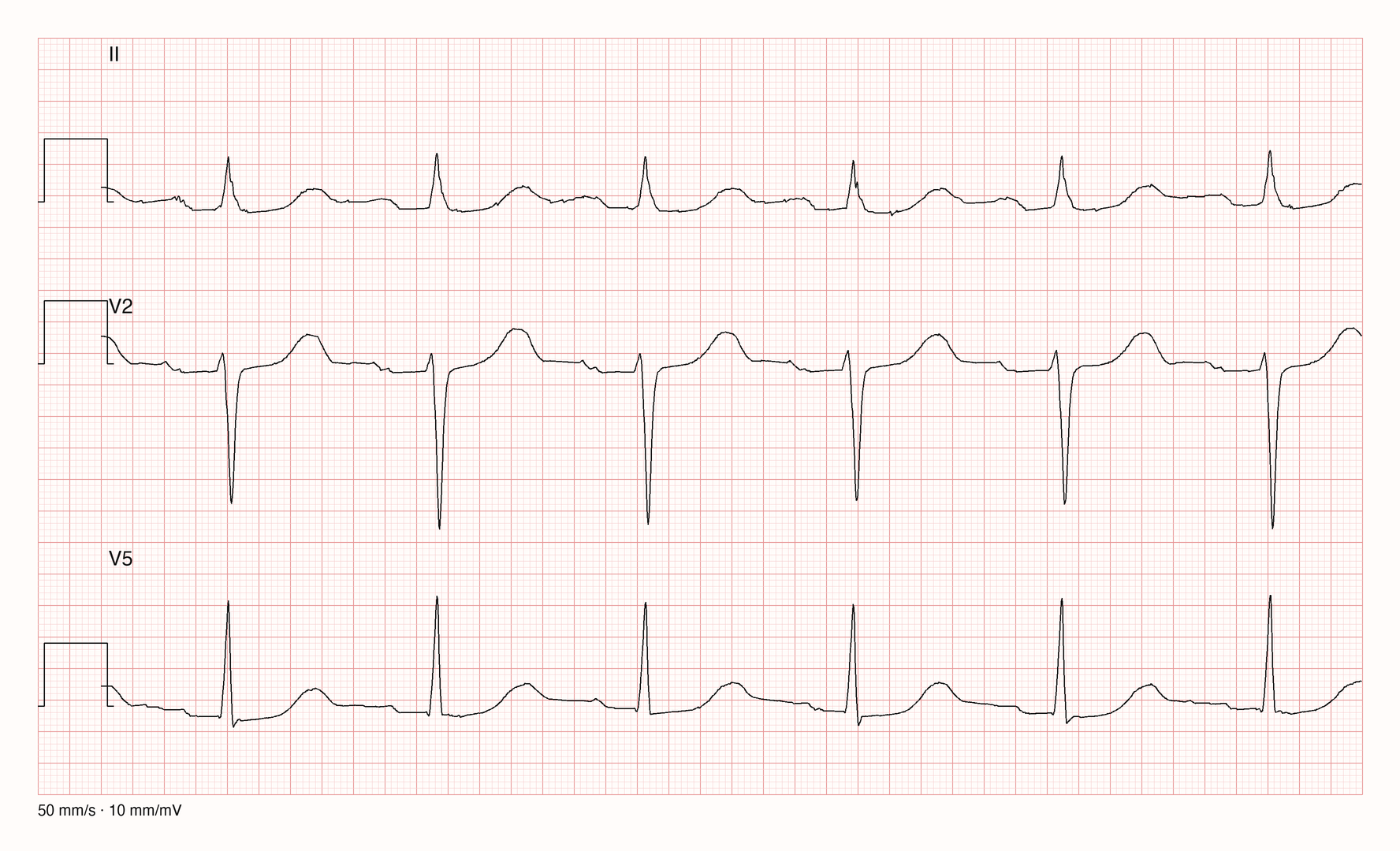 Ableitungen II, V2 und V5 bei 50 mm/s mit regelmäßigem Rhythmus um 91/min, schmalen QRS-Komplexen und gut abgrenzbaren T-Wellen