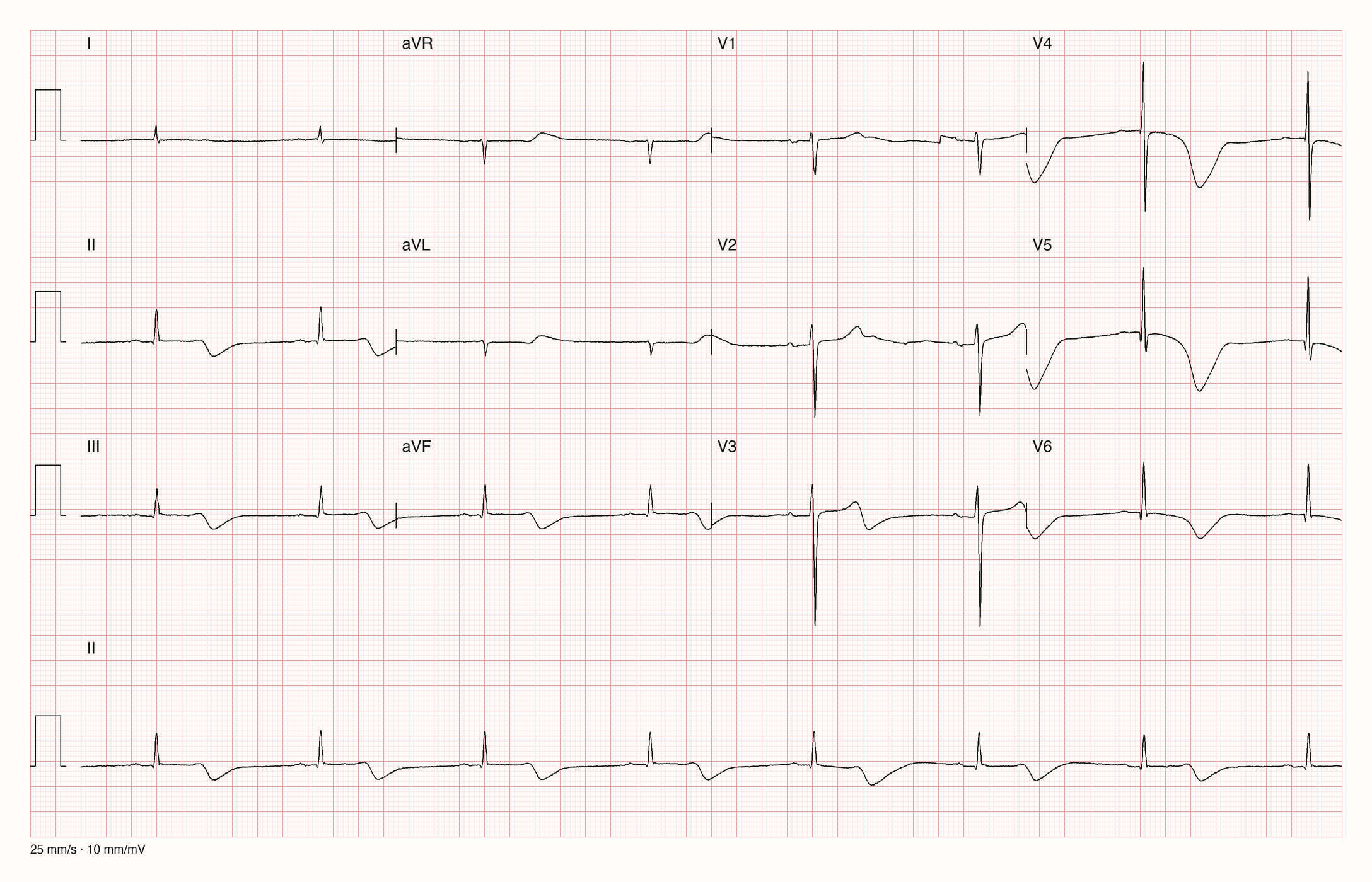 12-Kanal-EKG mit Rhythmusstreifen II: regelmäßiger langsamer Rhythmus um 46/min, schmale QRS-Komplexe; tiefe, breite negative T-Wellen in II, III, aVF und V4 bis V6, die erst spät nach dem QRS zur Grundlinie zurückkehren