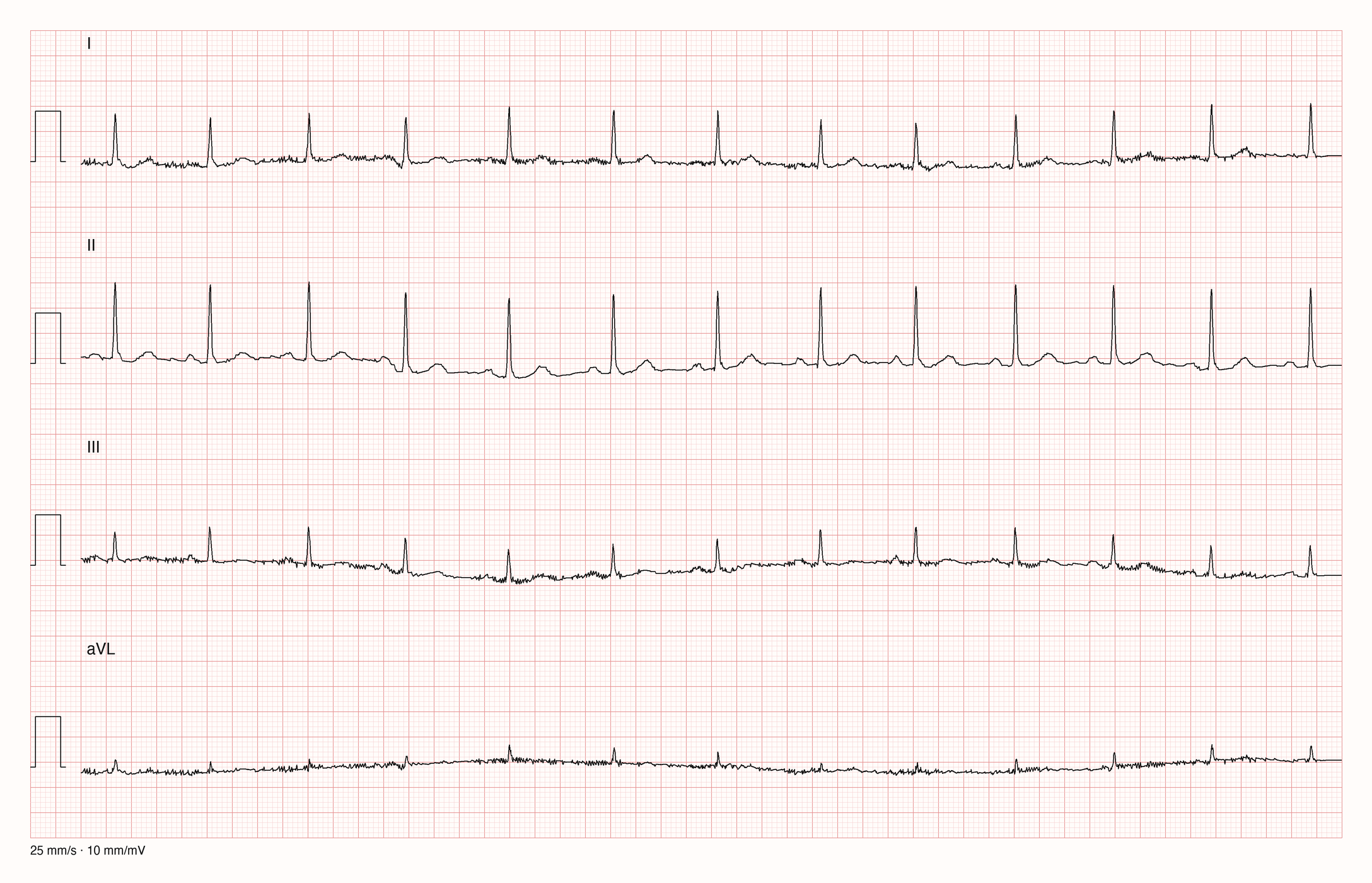 Ableitungen I, II, III und aVL über 10 s bei 25 mm/s und 10 mm/mV; feines hochfrequentes Zittern in I, III und aVL, II bleibt sauber; regelmäßige QRS-Komplexe