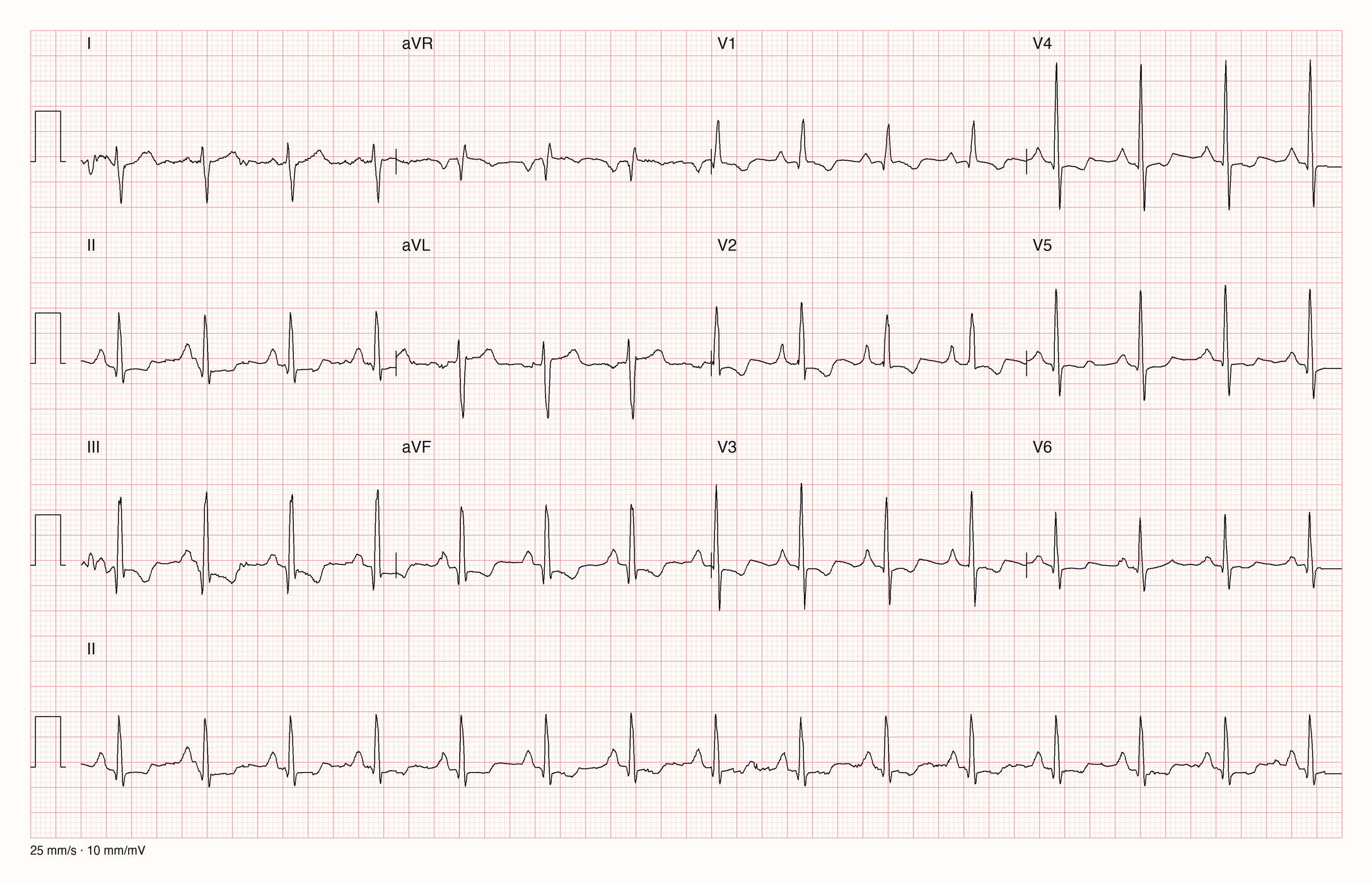 12-Kanal-EKG im Sinusrhythmus: negativer Hauptausschlag in I, hohe R-Zacken in III und aVF, hohe P-Wellen in II, dominante R-Zacke in V1 mit flach negativen T-Wellen in V1 und V2