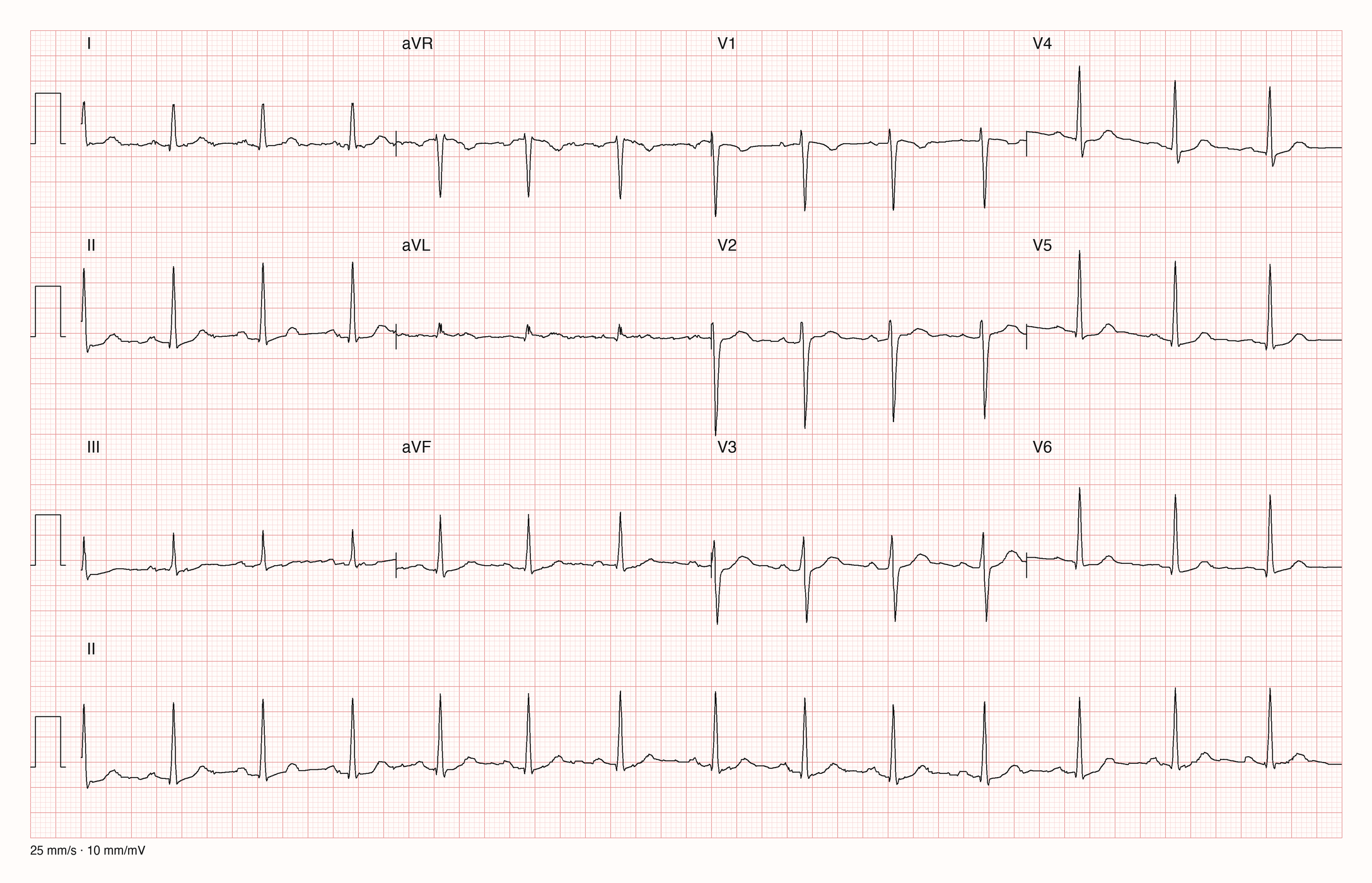 12-Kanal-EKG mit rS-Komplexen in V1 und V2, etwa gleich großer R- und S-Zacke in V3 und überwiegend positiven Komplexen ab V4