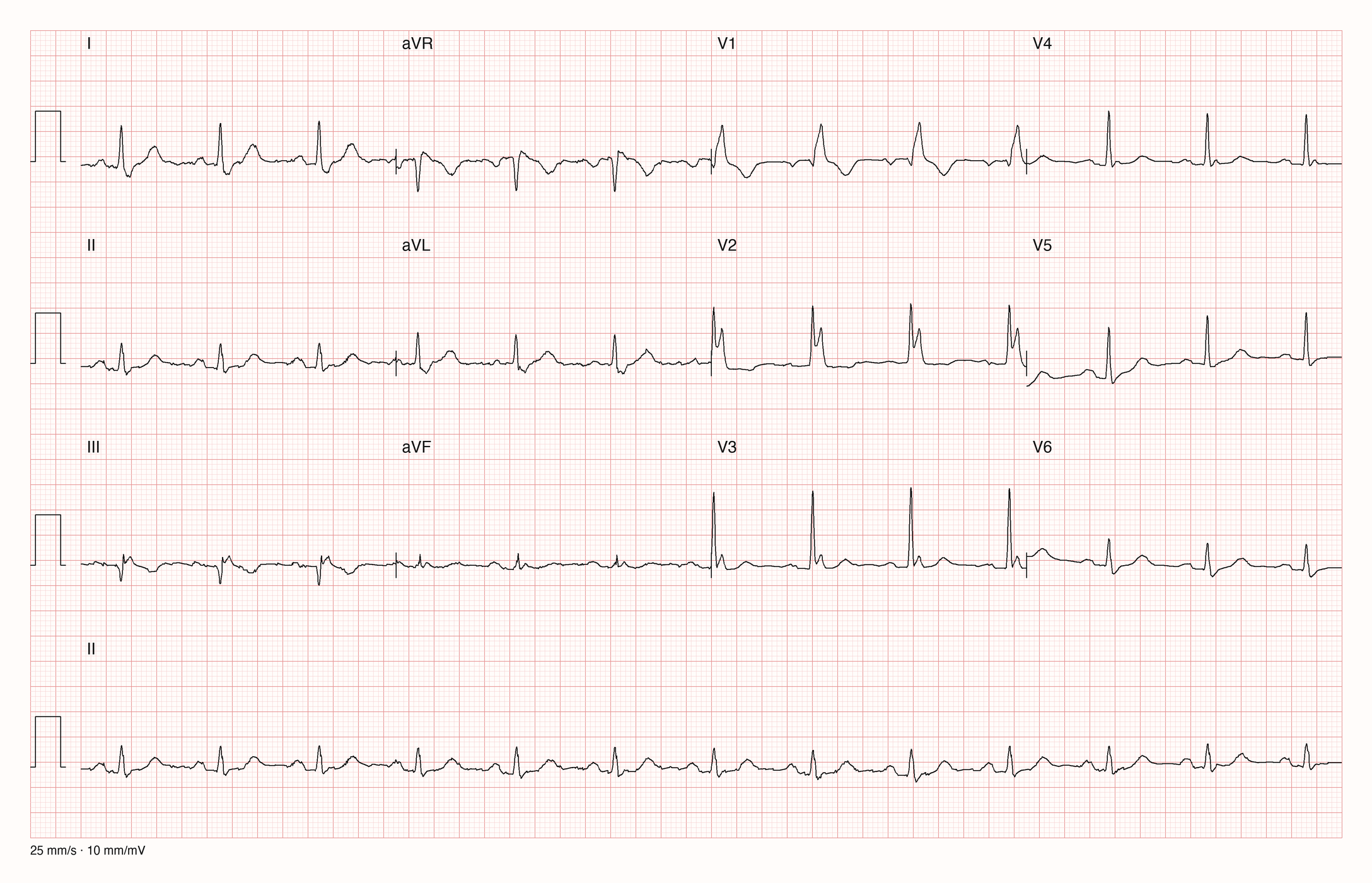 12-Kanal-EKG mit Rhythmusstreifen II: breite QRS-Komplexe, in V1 und V2 mit zweitem positivem Gipfel und nachfolgend negativer T-Welle, in I und V6 mit breitem, plumpem S am Ende des QRS
