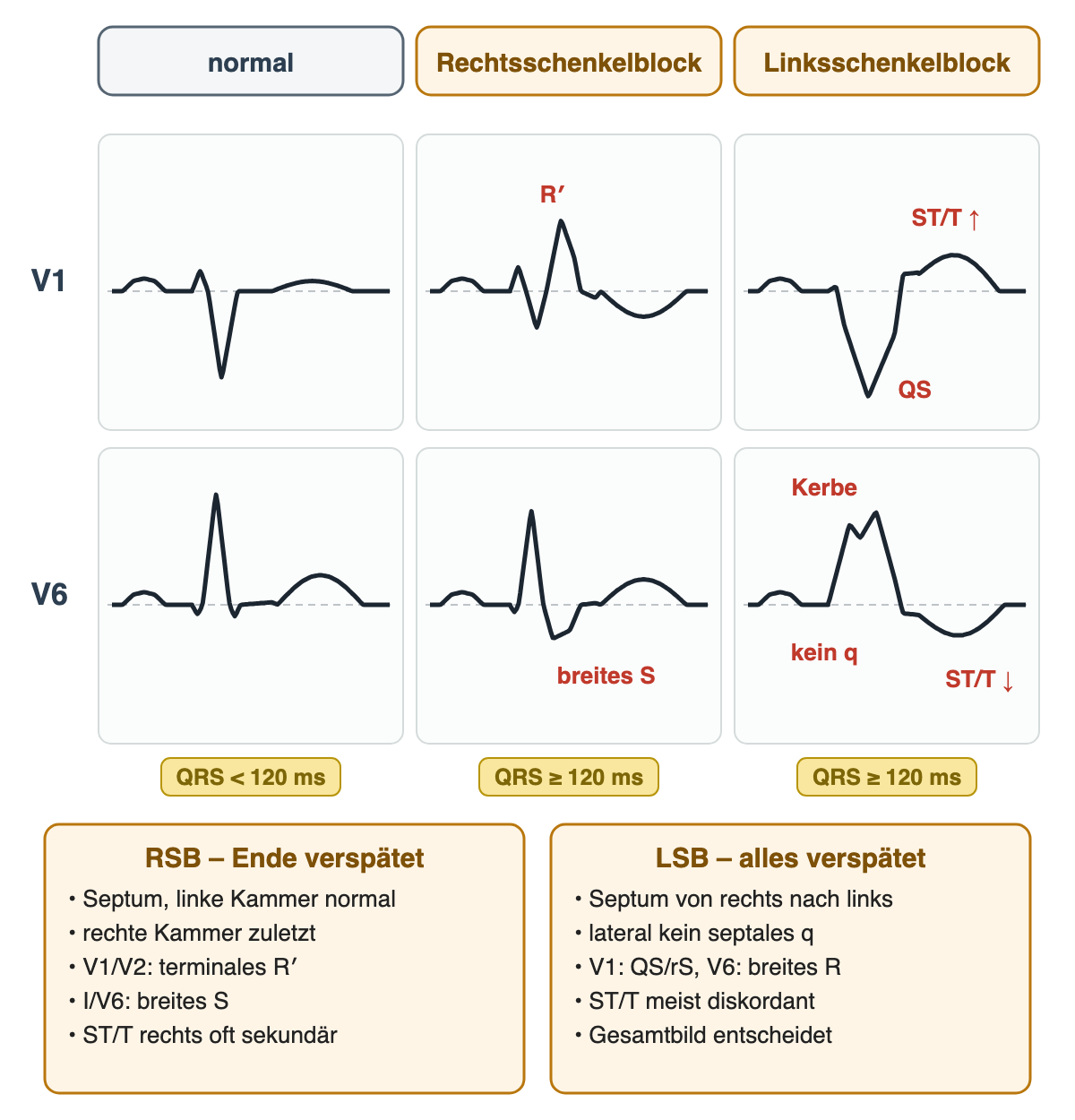 Schematische Kammerkomplexe in V1 und V6: normal schmal; Rechtsschenkelblock mit R′ in V1 und breitem S in V6; Linksschenkelblock mit QS in V1, gekerbtem breitem R ohne q in V6 und diskordantem ST/T; darunter der Mechanismus beider Blöcke