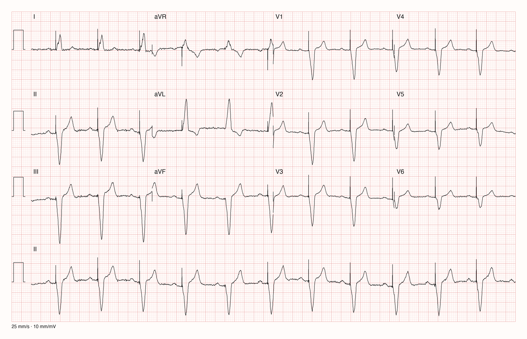 Zwölf-Kanal-EKG mit Rhythmusstreifen II: vor jedem QRS ein schmaler Spike, danach ein breiter QRS; in I positiv, in II, III und aVF tief negativ, in V1 bis V6 überwiegend negativ; T-Wellen gegensinnig zum QRS; regelmäßig um 70/min