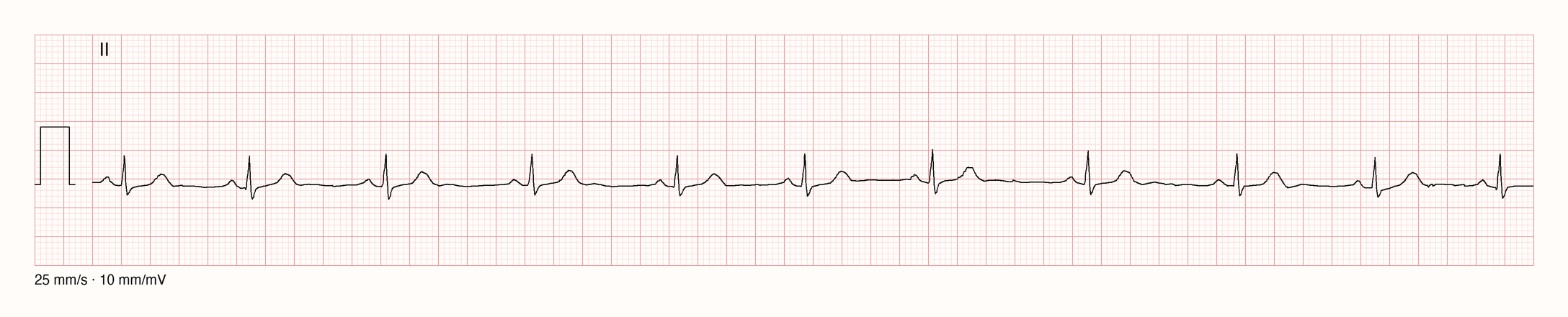 Ableitung II über 10 s: gleichförmige P-Wellen vor jedem QRS, die RR-Abstände wechseln gleitend zwischen etwa 0,87 und 1,08 s; respiratorische Sinusarrhythmie