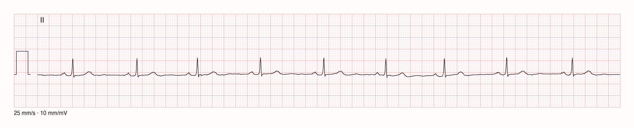 Ableitung II über 10 s: neun schmale QRS-Komplexe mit RR etwa 1,0–1,1 s, vor jedem QRS eine gleichförmige positive P-Welle; Sinusbradykardie um 55/min