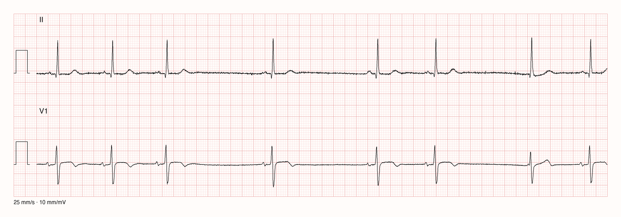 Rhythmusstreifen in Ableitung II und V1 über 10 Sekunden: drei regelmäßige Schläge mit P-Welle, dann zwei lange Pausen, die jeweils mit P-Welle und QRS enden, später ein schmaler QRS ohne vorangehende P-Welle nach einer Pause