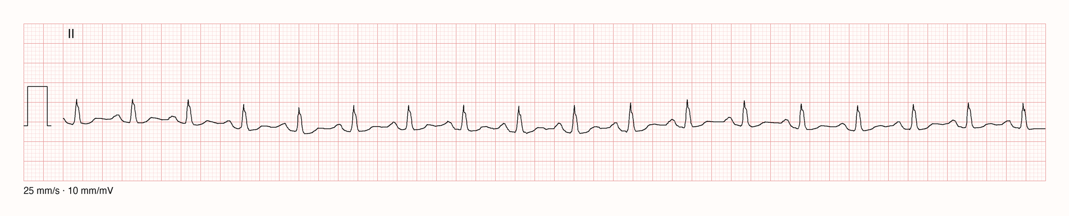 Ableitung II über 10 s: 18 schmale QRS-Komplexe mit RR etwa 0,56 s, vor jedem QRS eine positive P-Welle; Sinustachykardie um 105/min