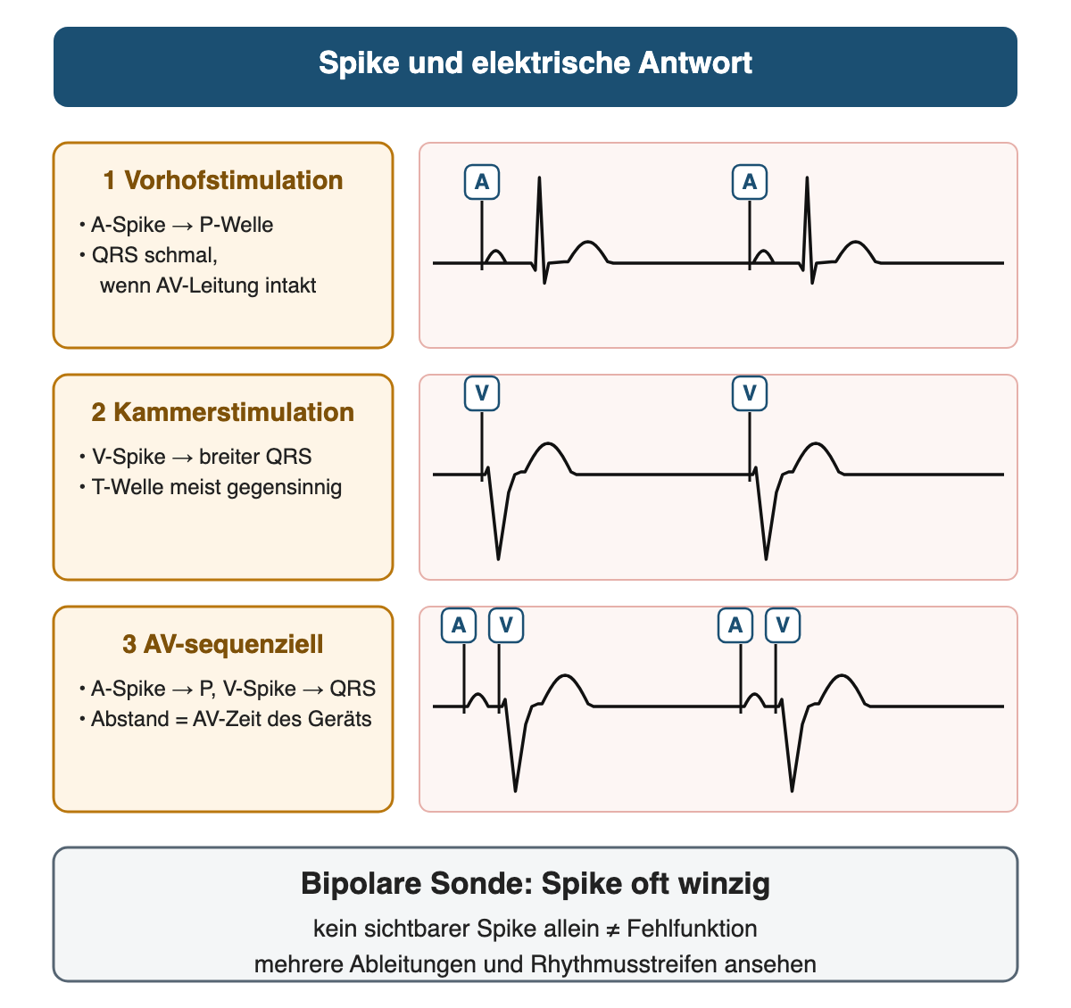 Drei schematische Streifen: Vorhofstimulation mit A-Spike, P-Welle und schmalem QRS; Kammerstimulation mit V-Spike, breitem QRS und gegensinniger T-Welle; AV-sequenzielle Stimulation mit A-Spike vor der P-Welle und V-Spike vor dem breiten QRS; darunter der Hinweis, dass bipolare Spikes winzig sein können