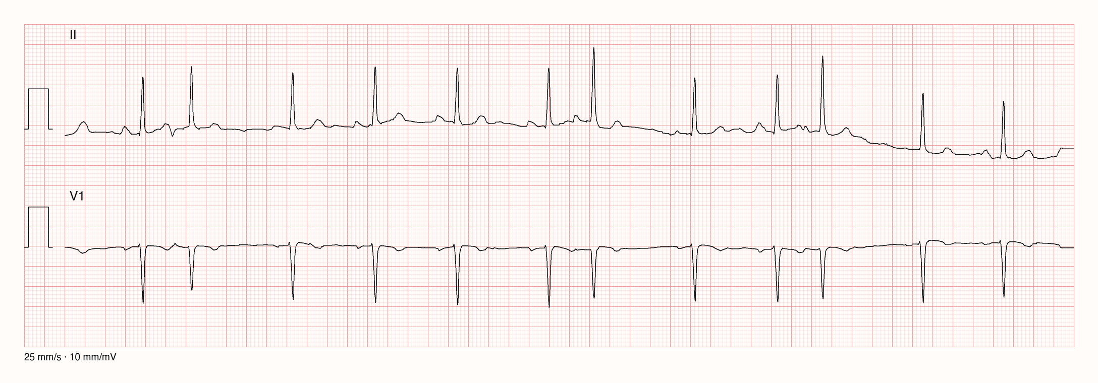 Ableitungen II und V1 über 10 s: Sinusrhythmus mit RR etwa 0,82 s und drei vorzeitigen schmalen Schlägen bei etwa 1,3 s, 5,3 s und 7,5 s; QRS-Form ähnlich den Grundschlägen, kleine vorzeitige P-Welle dicht hinter der vorausgehenden T-Welle; Pause danach kürzer als zwei Grund-RR