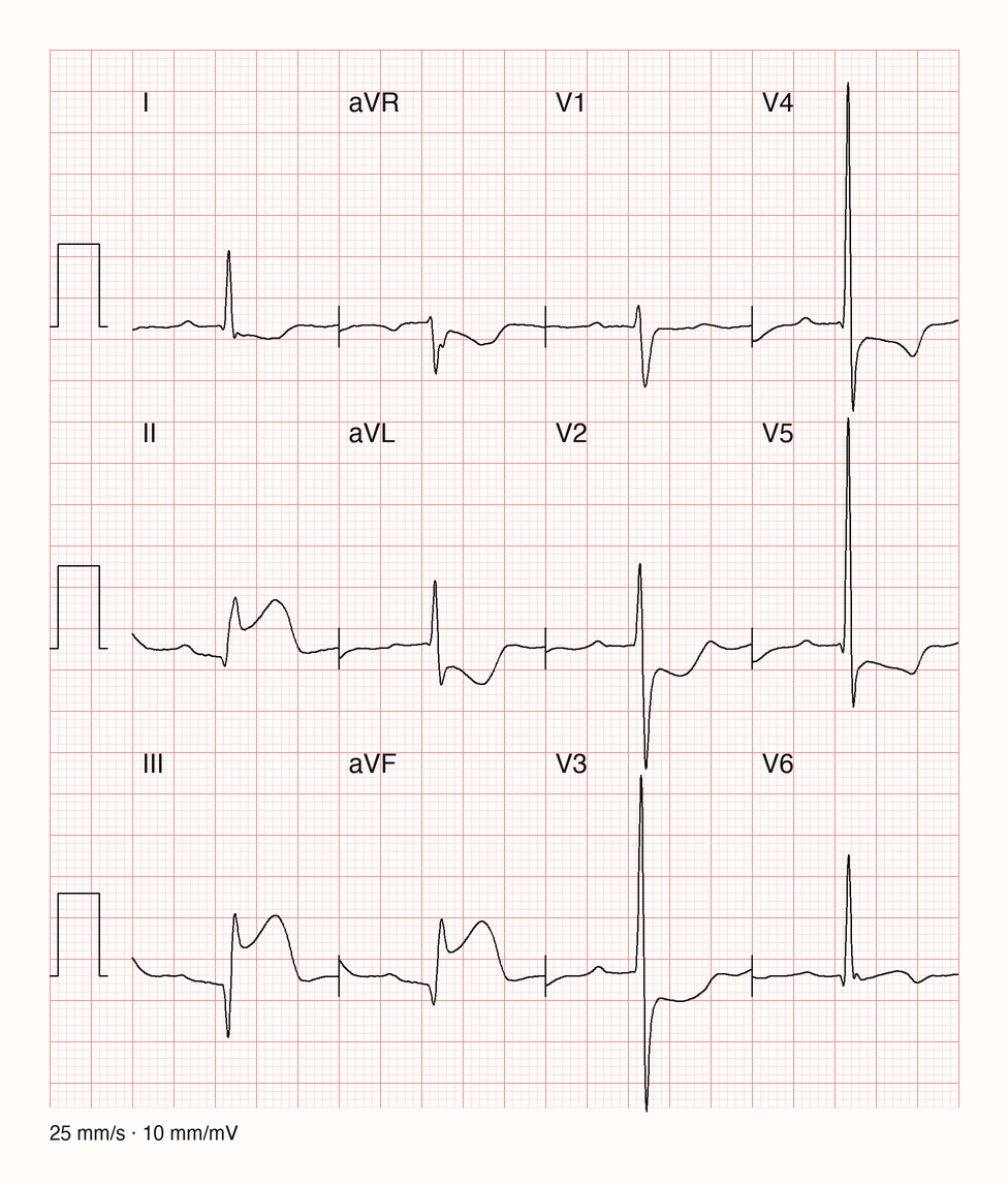 12-Kanal-Medianschlag mit schmalem QRS: ST-Hebung in II, III und aVF, in III am deutlichsten; in aVL ST-Senkung mit negativer T-Welle, auch in I und aVR leichte ST-Senkung; in V2 und V3 ST-Senkung; in V4 bis V6 negative terminale T-Wellen