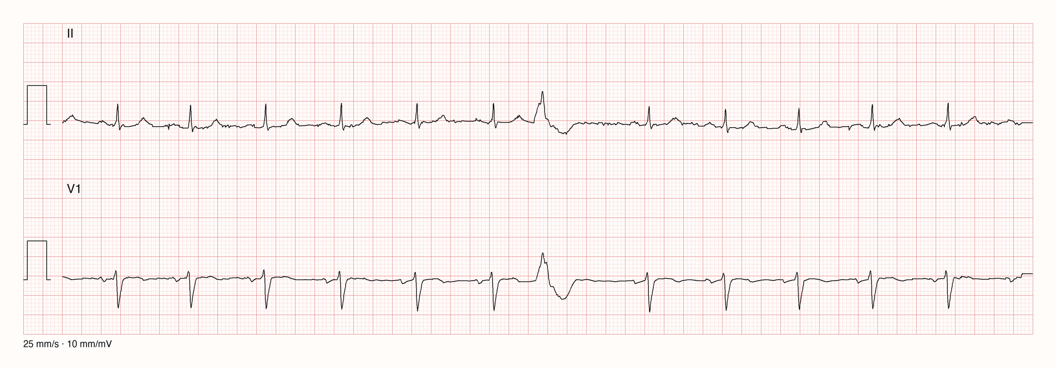 Ableitungen II und V1 über 10 s: Sinusrhythmus mit RR etwa 0,78 s; bei etwa 5 s ein vorzeitiger, breiter, anders geformter QRS ohne vorangehende P-Welle mit gegensinniger ST/T-Strecke; Kopplungsintervall etwa 0,53 s, folgende Pause etwa 1,07 s