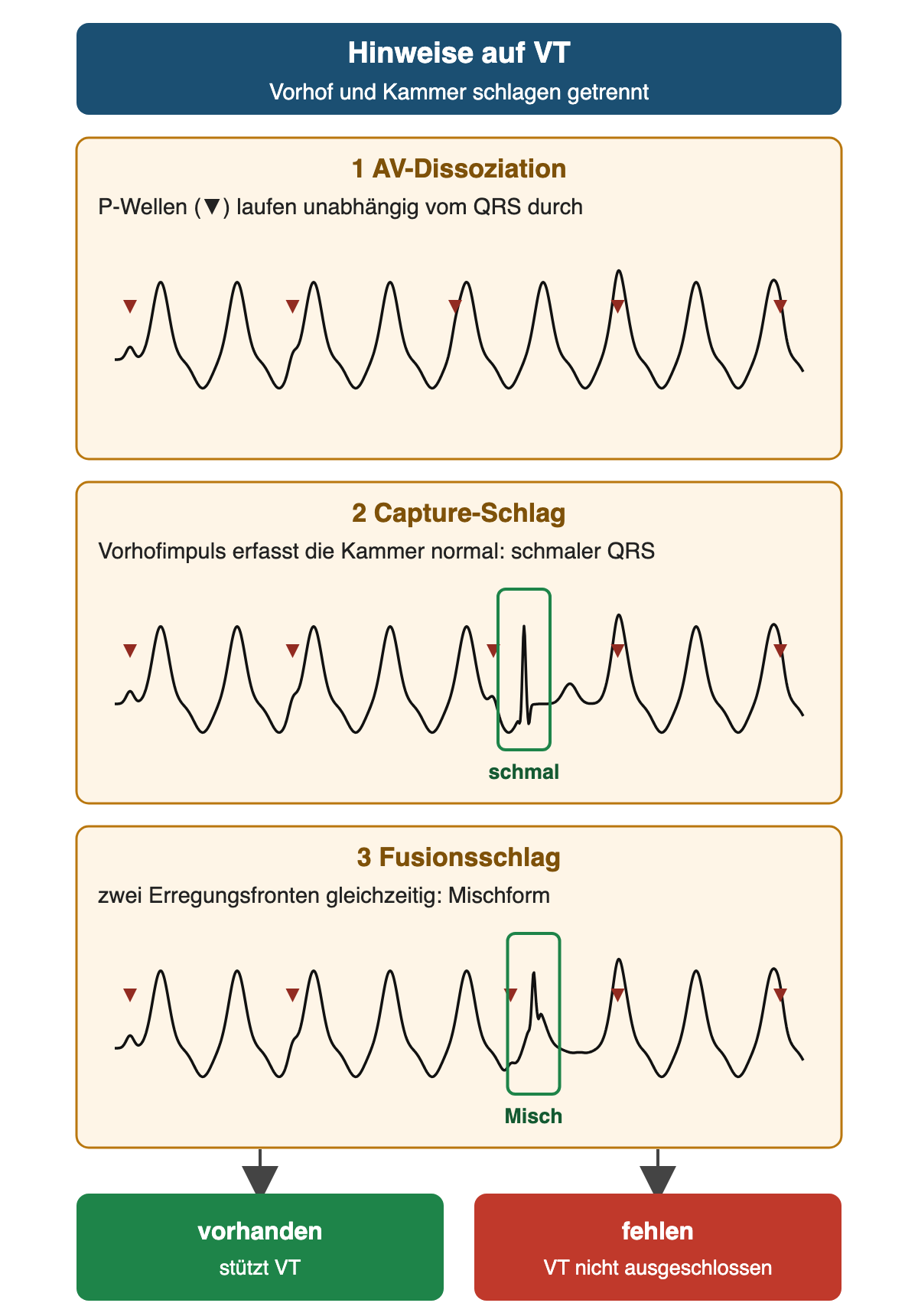 Drei schematische Rhythmusstreifen einer Breitkomplextachykardie: P-Wellen laufen unabhängig durch (AV-Dissoziation), ein vorzeitiger schmaler QRS (Capture-Schlag) und ein QRS in Mischform (Fusionsschlag); vorhanden stützt VT, fehlen schließt VT nicht aus