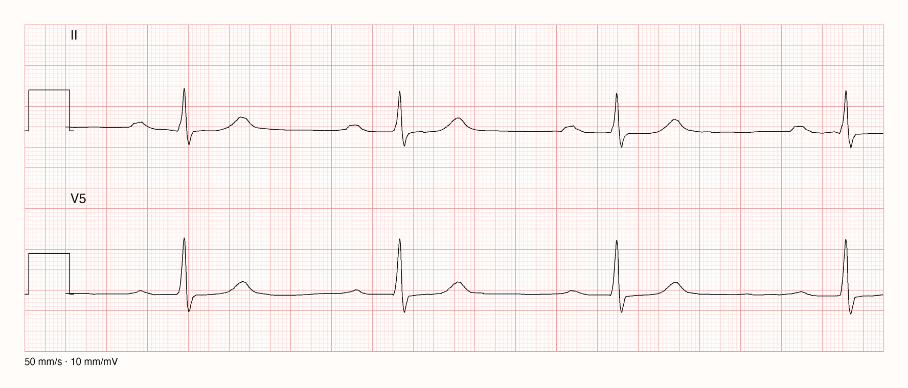 Ableitungen II und V5 bei 50 mm/s: vor jedem schmalen QRS eine P-Welle mit deutlich langem Abstand bis zum QRS-Beginn