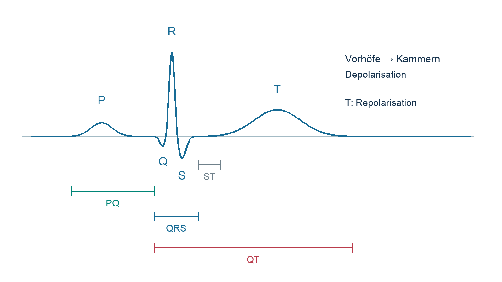P-QRS-T-Zyklus mit Grenzen von PQ QRS ST und QT