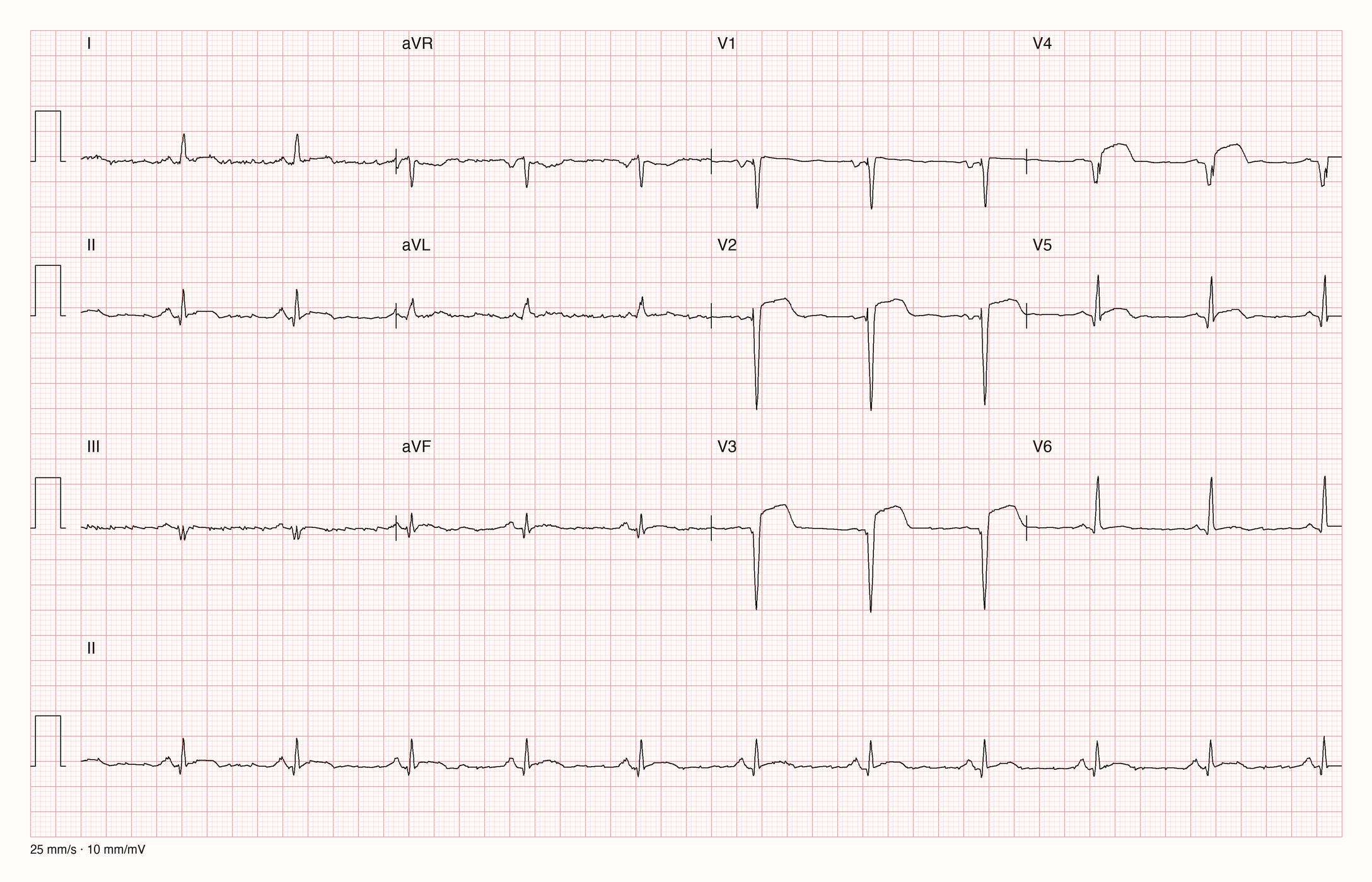 Reale EKG-Aufzeichnung mit zwölf Ableitungen; Aufnahme C03-U17-Q01; Skalierung im Bild