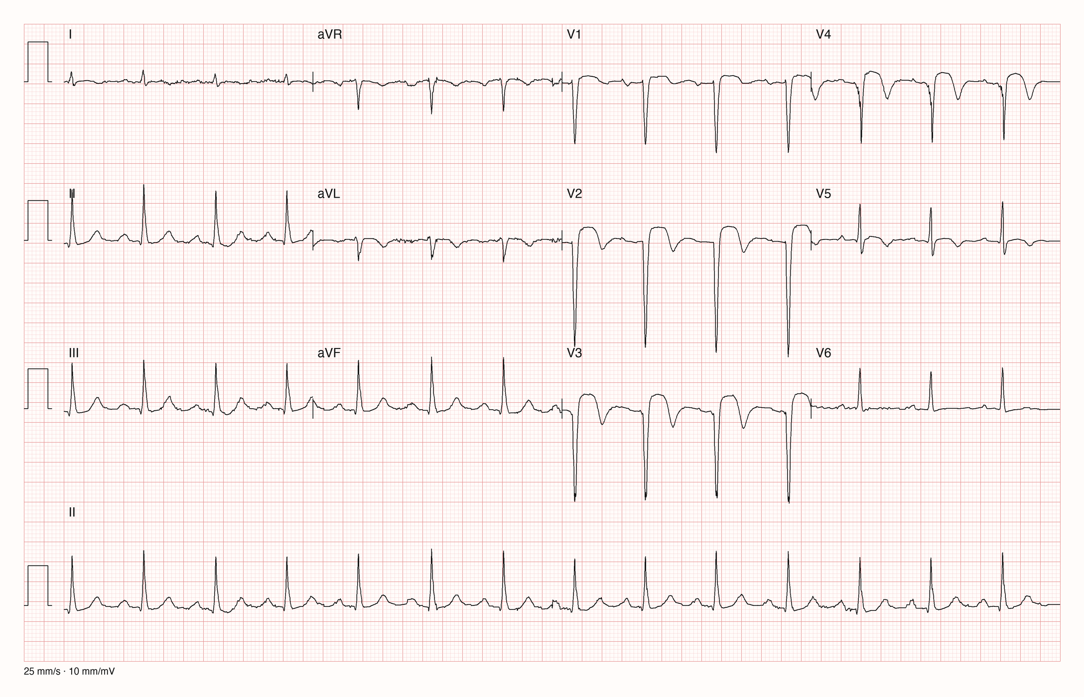 Reale EKG-Aufzeichnung mit zwölf Ableitungen; Aufnahme C03-U17-Q02; Skalierung im Bild
