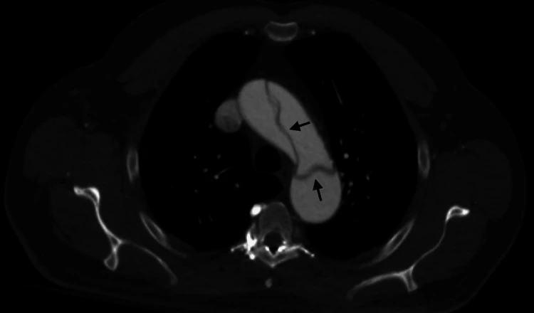 Axiale Kontrastmittel-CT des Thorax auf Höhe des Aortenbogens: dünne dunkle Membran im hell kontrastierten Aortenlumen, zwei schwarze Pfeile