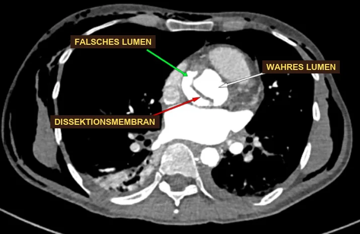 Axiale kontrastverstärkte CT des Thorax auf Höhe der aufsteigenden Aorta: eine dünne Membran trennt in der aufsteigenden Aorta ein helles wahres von einem falschen Lumen, deutsche Beschriftungen mit Pfeilen