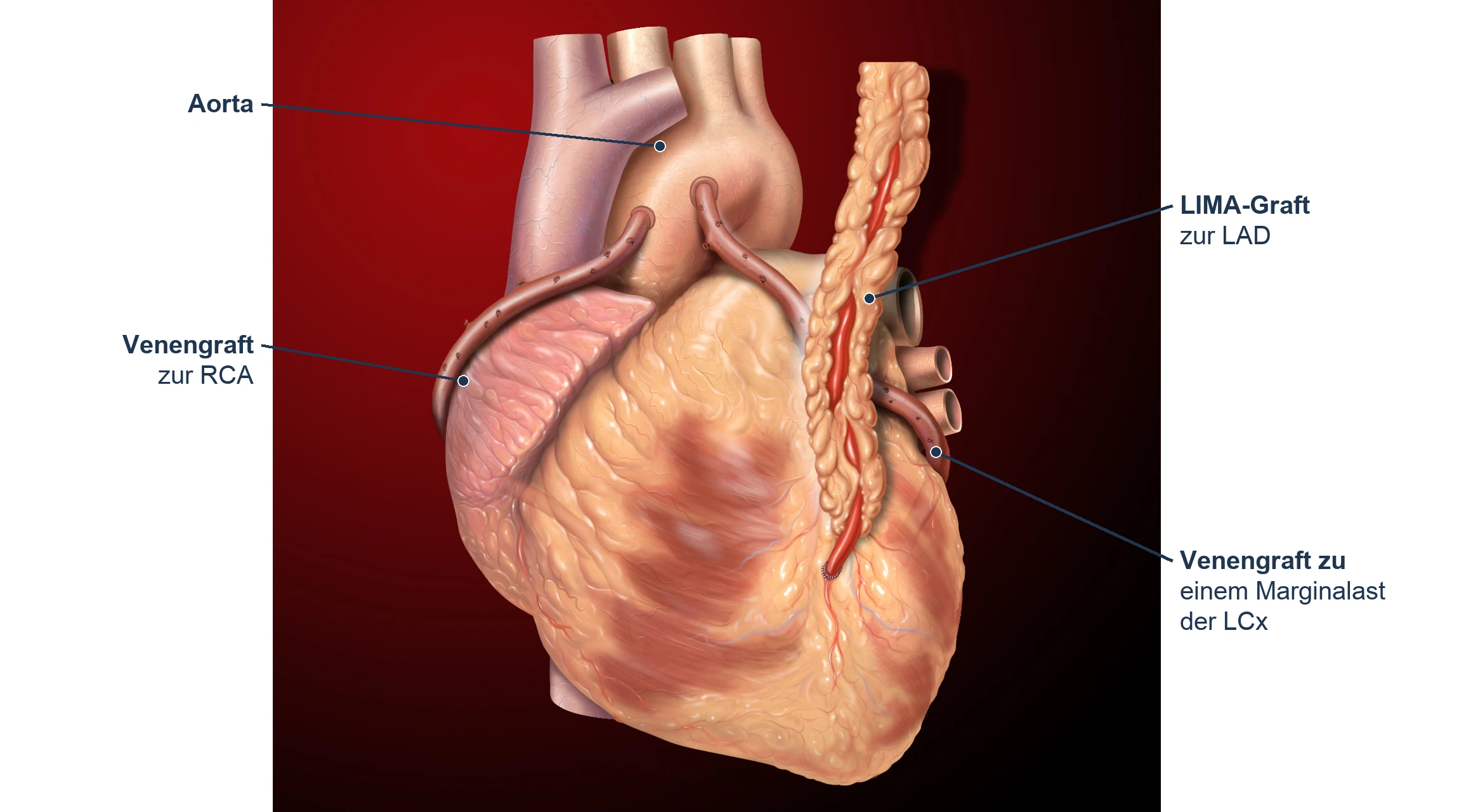 Illustration eines Herzens mit drei Bypassgrafts: LIMA zur LAD und zwei Venengrafts von der Aorta