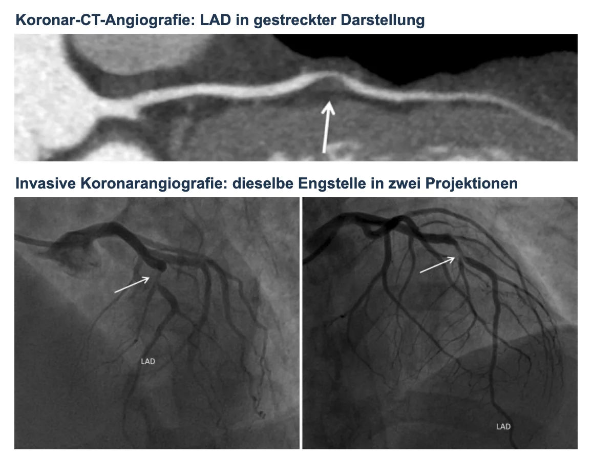 Oben gestreckte CCTA-Darstellung der LAD mit nicht verkalkter Engstelle (Pfeil), unten invasive Koronarangiografie derselben Engstelle in zwei Projektionen (Pfeile)