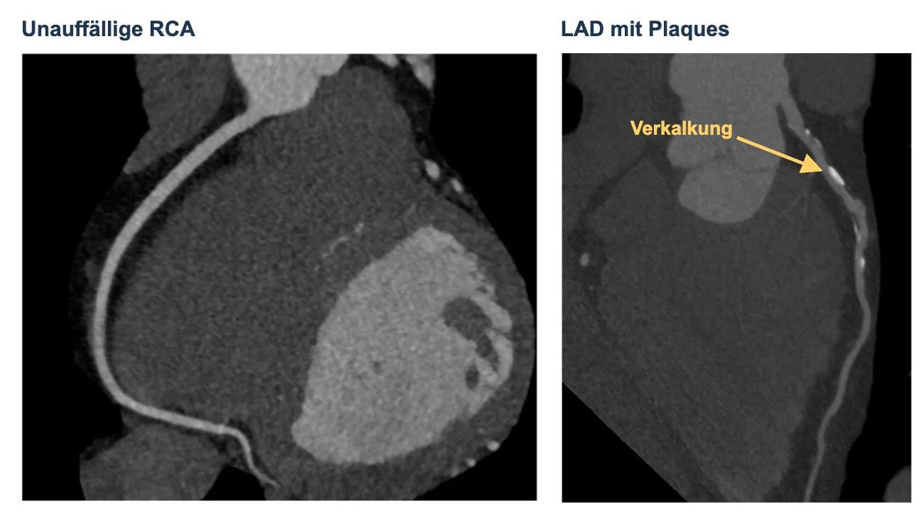 Koronar-CT-Angiografie in längs rekonstruierter Darstellung: links eine glatt kontrastierte rechte Koronararterie, rechts eine LAD mit hellen Kalkherden in der proximalen Gefäßwand