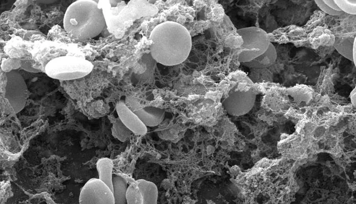 Rasterelektronenmikroskopische Aufnahme: rote Blutkörperchen, eingefangen in einem dichten Netz aus Fibrinfäden