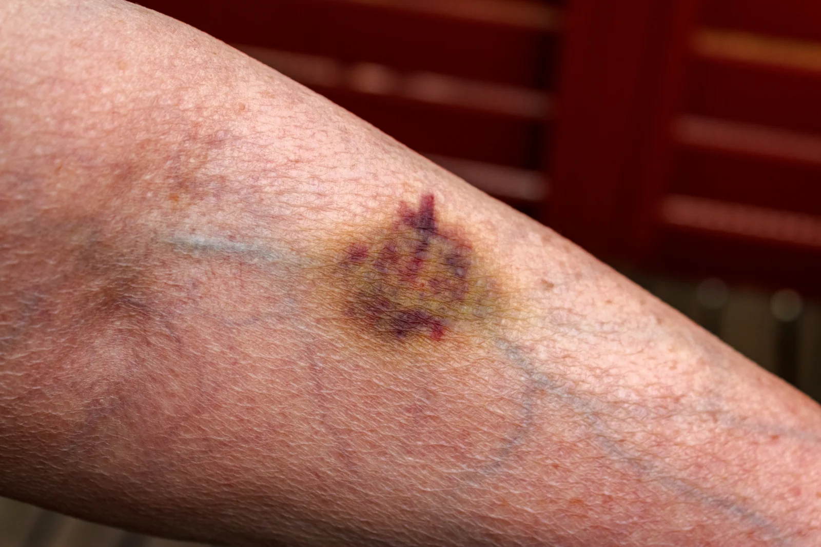 Unterarm mit etwa münzgroßem, blau-violettem Bluterguss mit gelblich-grünem Randsaum über einer oberflächlichen Vene; übrige Haut unauffällig