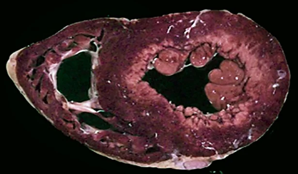 Querschnitt durch beide Herzkammern nach Nitroblau-Tetrazolium-Färbung: violett gefärbtes vitales Myokard außen, ringförmig blasse Zone unter dem Endokard des linken Ventrikels