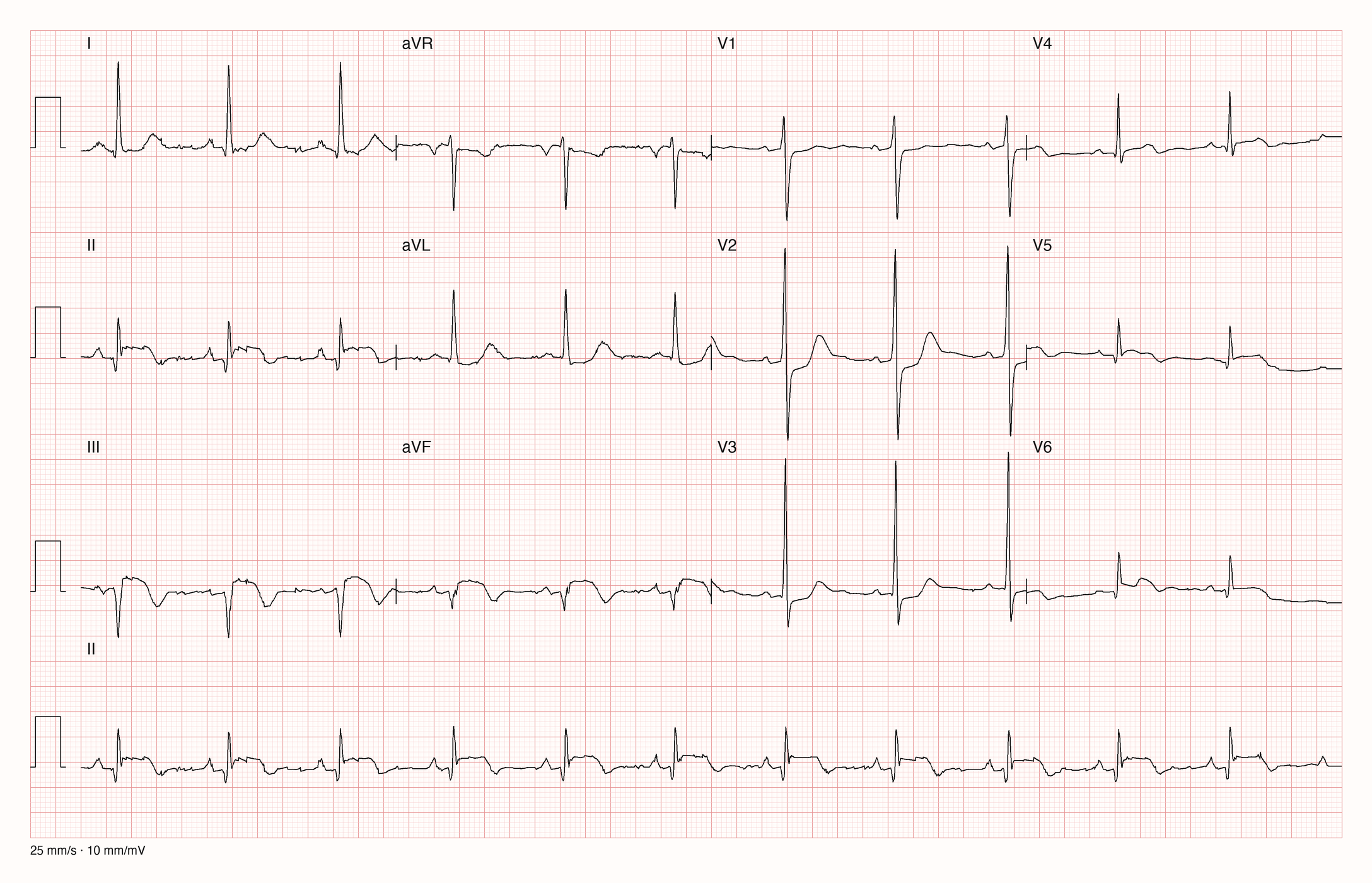 Reale EKG-Aufzeichnung mit zwölf Ableitungen; Aufnahme C03-U04-Q02; Skalierung im Bild