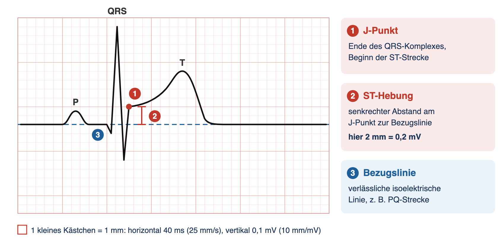 Schematischer Herzzyklus auf EKG-Raster: J-Punkt am Ende des QRS, ST-Strecke 2 mm über der gestrichelten isoelektrischen Bezugslinie, Messklammer am J-Punkt
